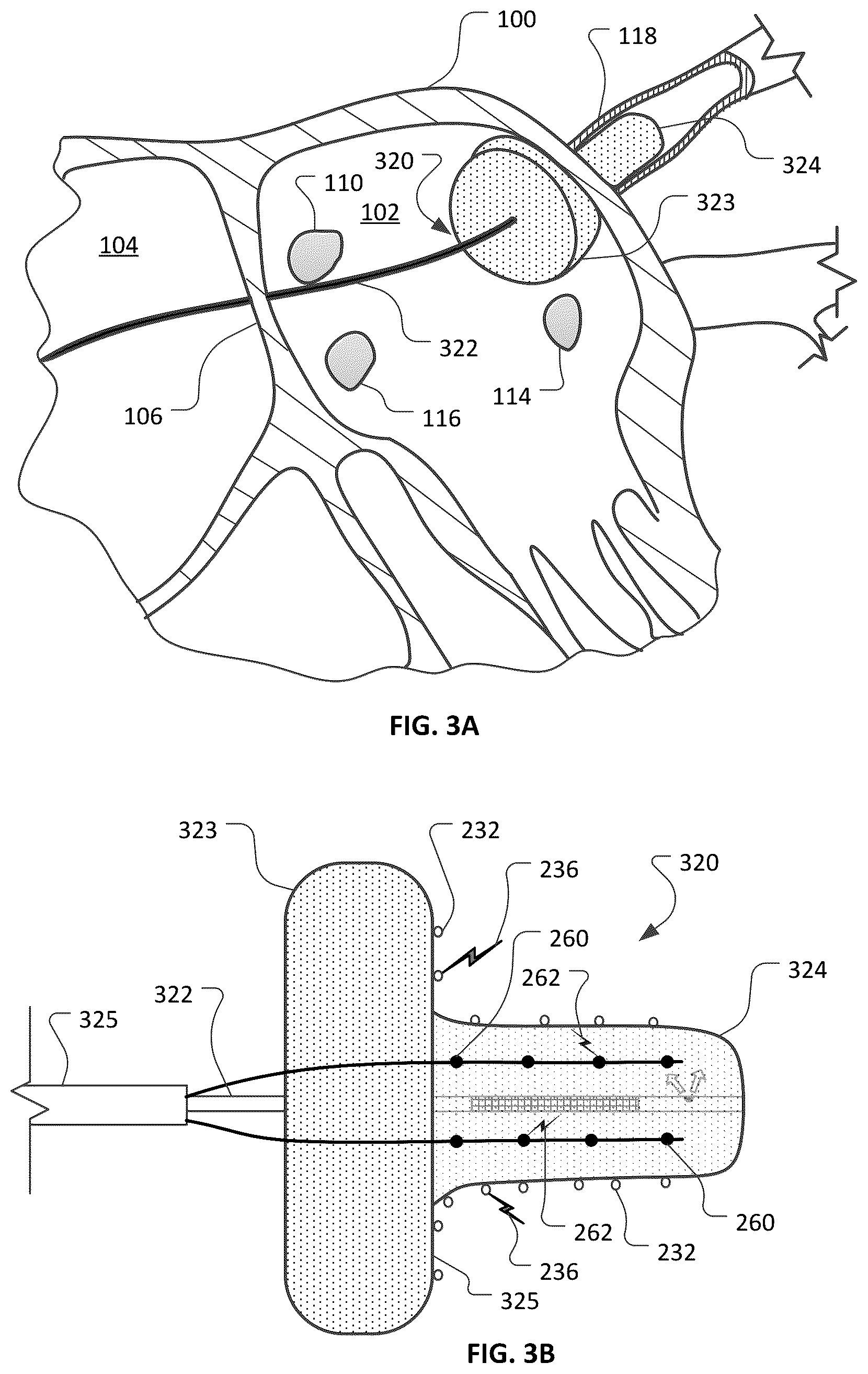Patent US12426947 Figure 5 – Devices and methods for ablation of tissue