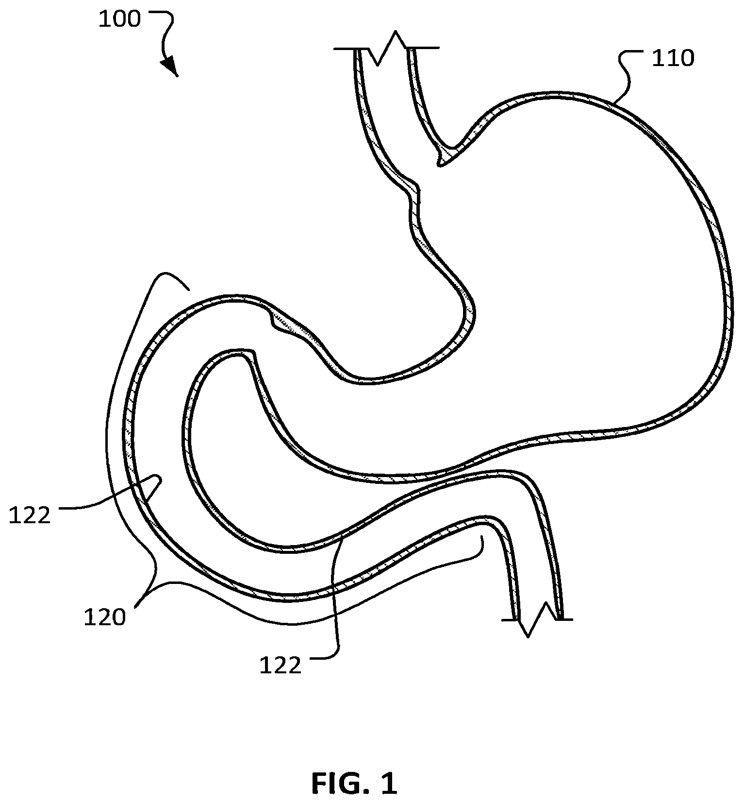 Patent US12426948 Figure 1 – Electroporation for obesity or diabetes treatment