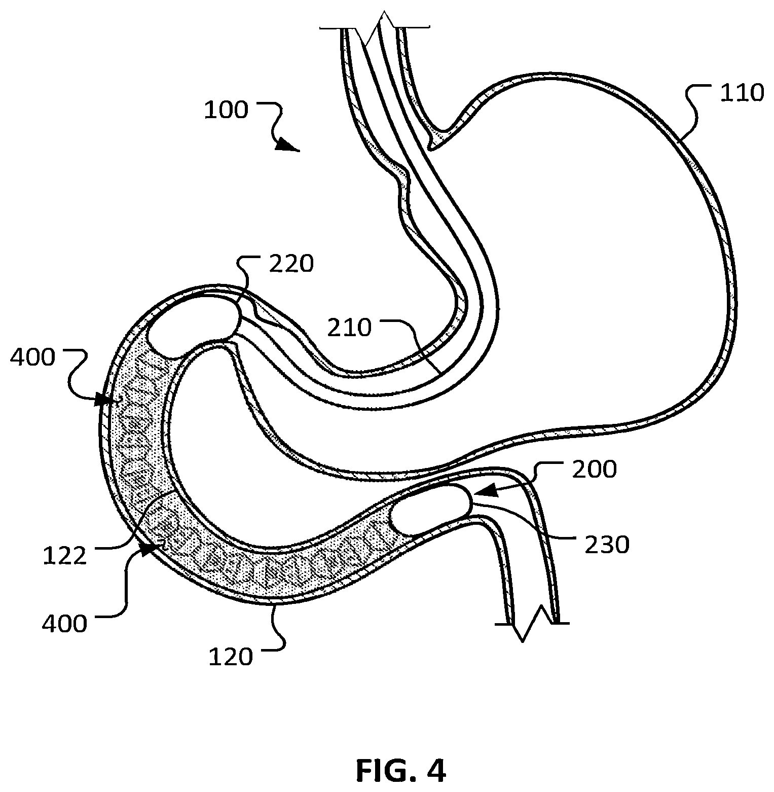 Patent US12426948 Figure 3 – Electroporation for obesity or diabetes treatment