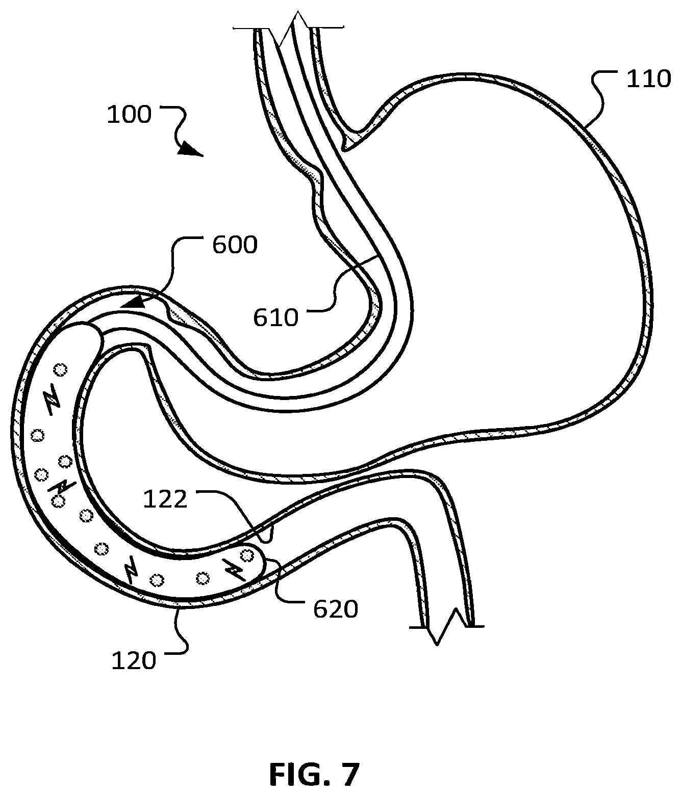 Patent US12426948 Figure 5 – Electroporation for obesity or diabetes treatment