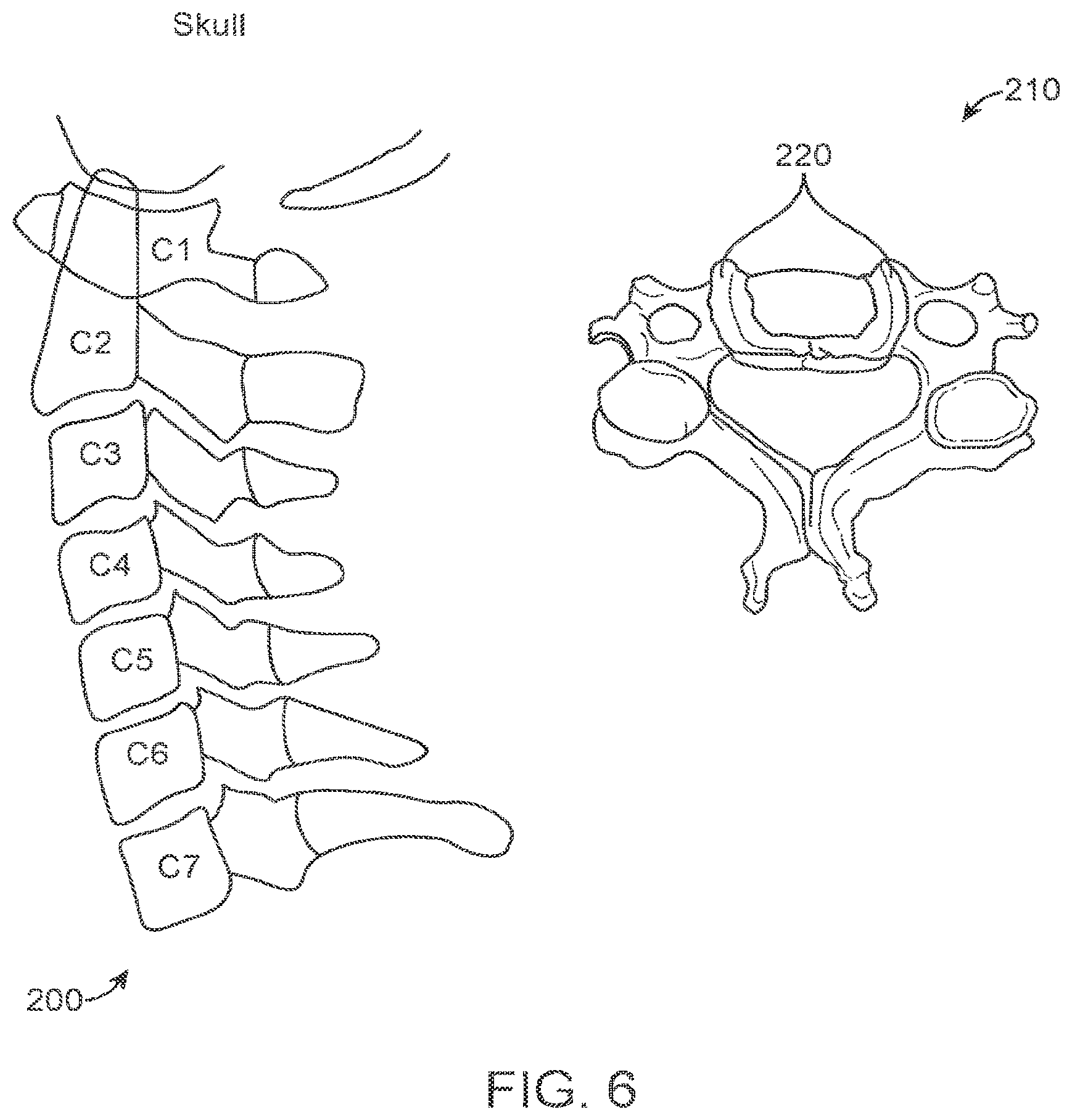 Patent US12426951 Figure 5 – Robotic system and method for bone preparation for intervertebral disc prosthesis implantation