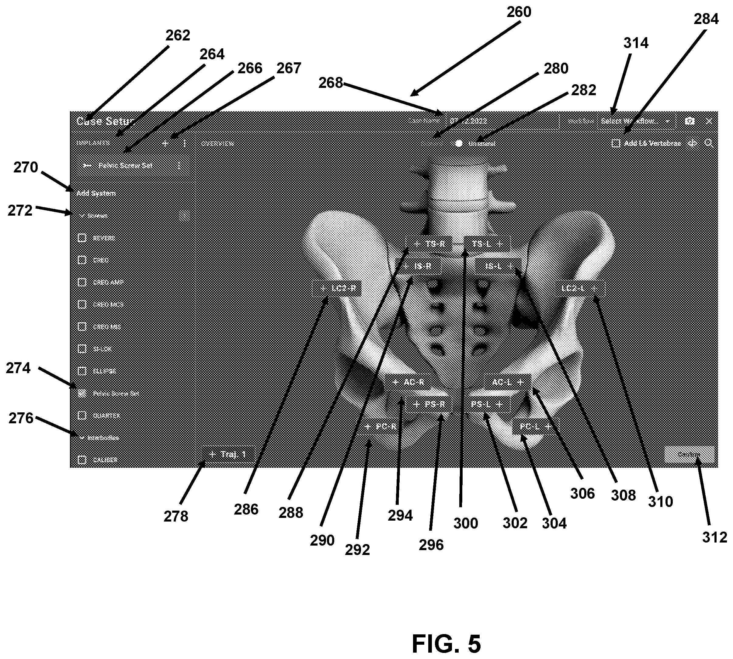 Patent US12426958 Figure 5 – Navigated pelvic implant system and associated method of use