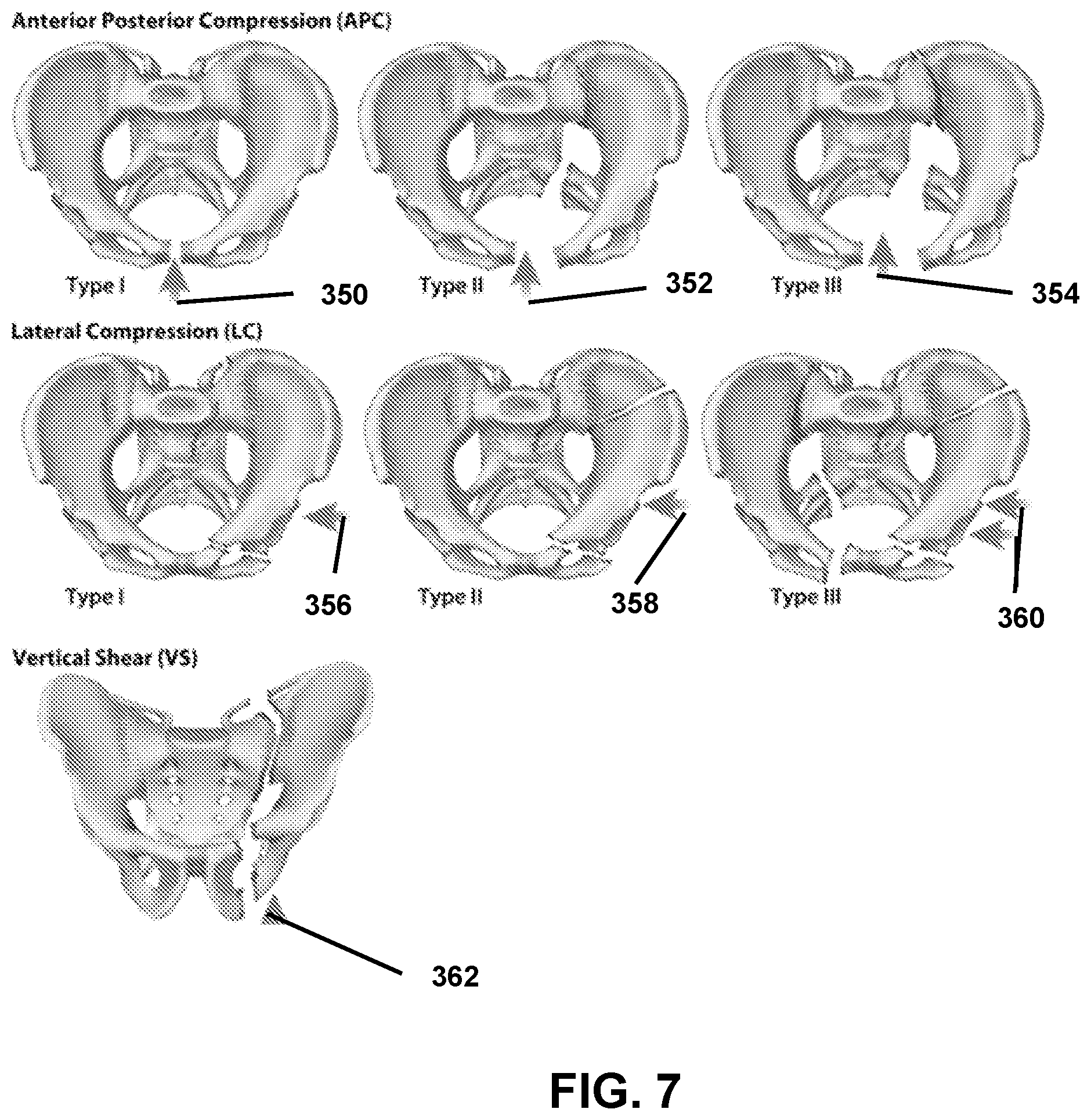 Patent US12426958 Figure 7 – Navigated pelvic implant system and associated method of use