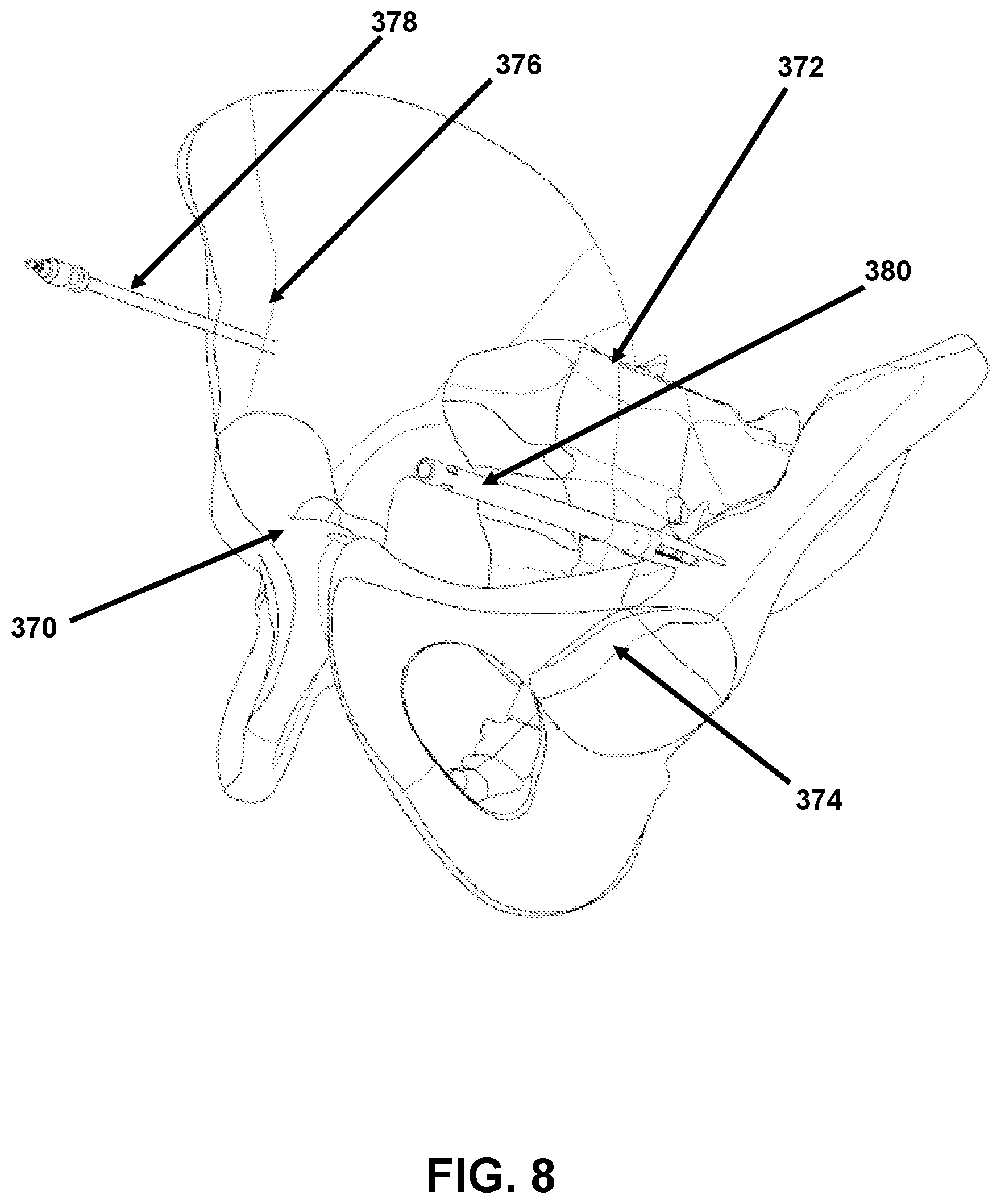 Patent US12426958 Figure 8 – Navigated pelvic implant system and associated method of use