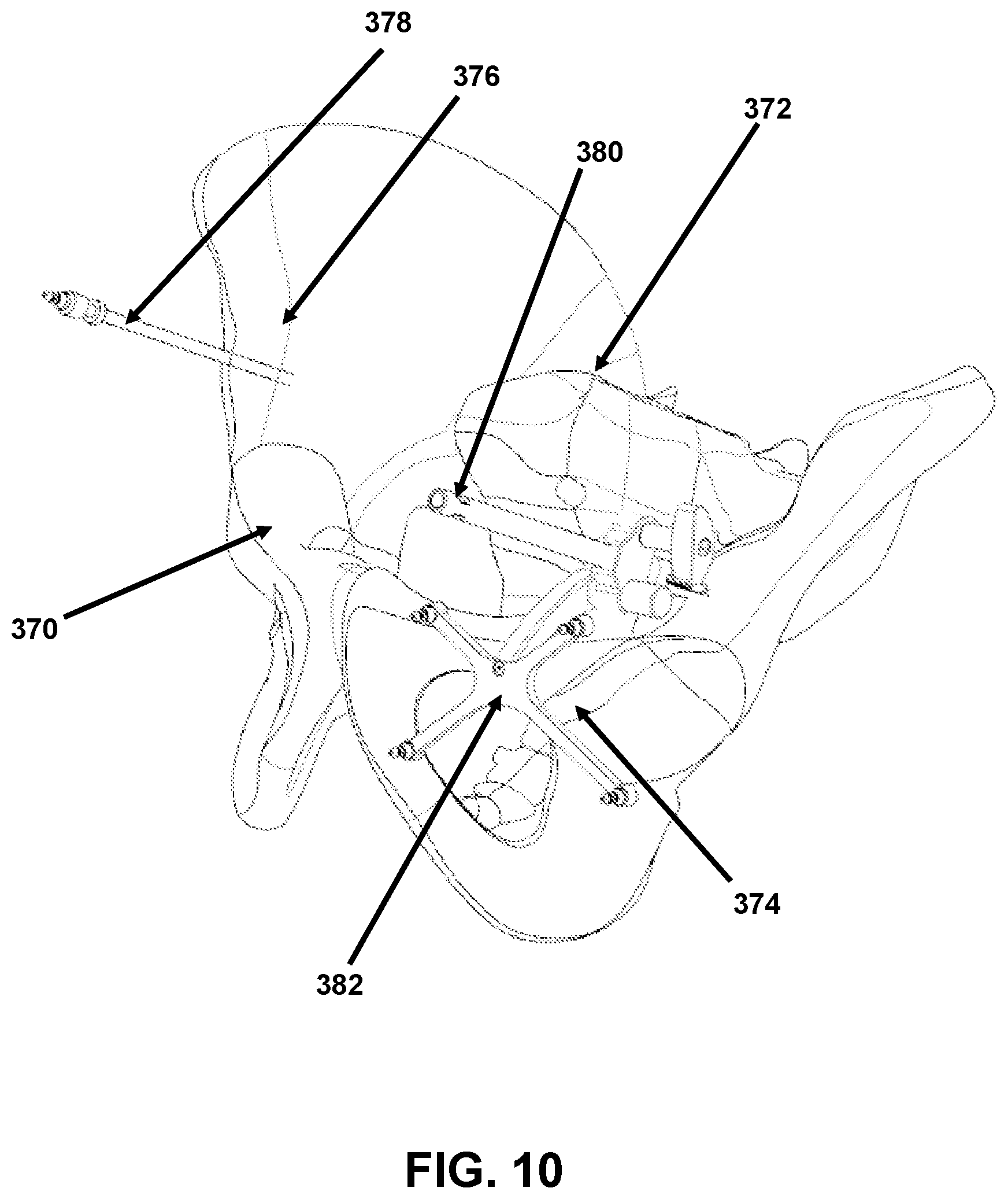 Patent US12426958 Figure 10 – Navigated pelvic implant system and associated method of use