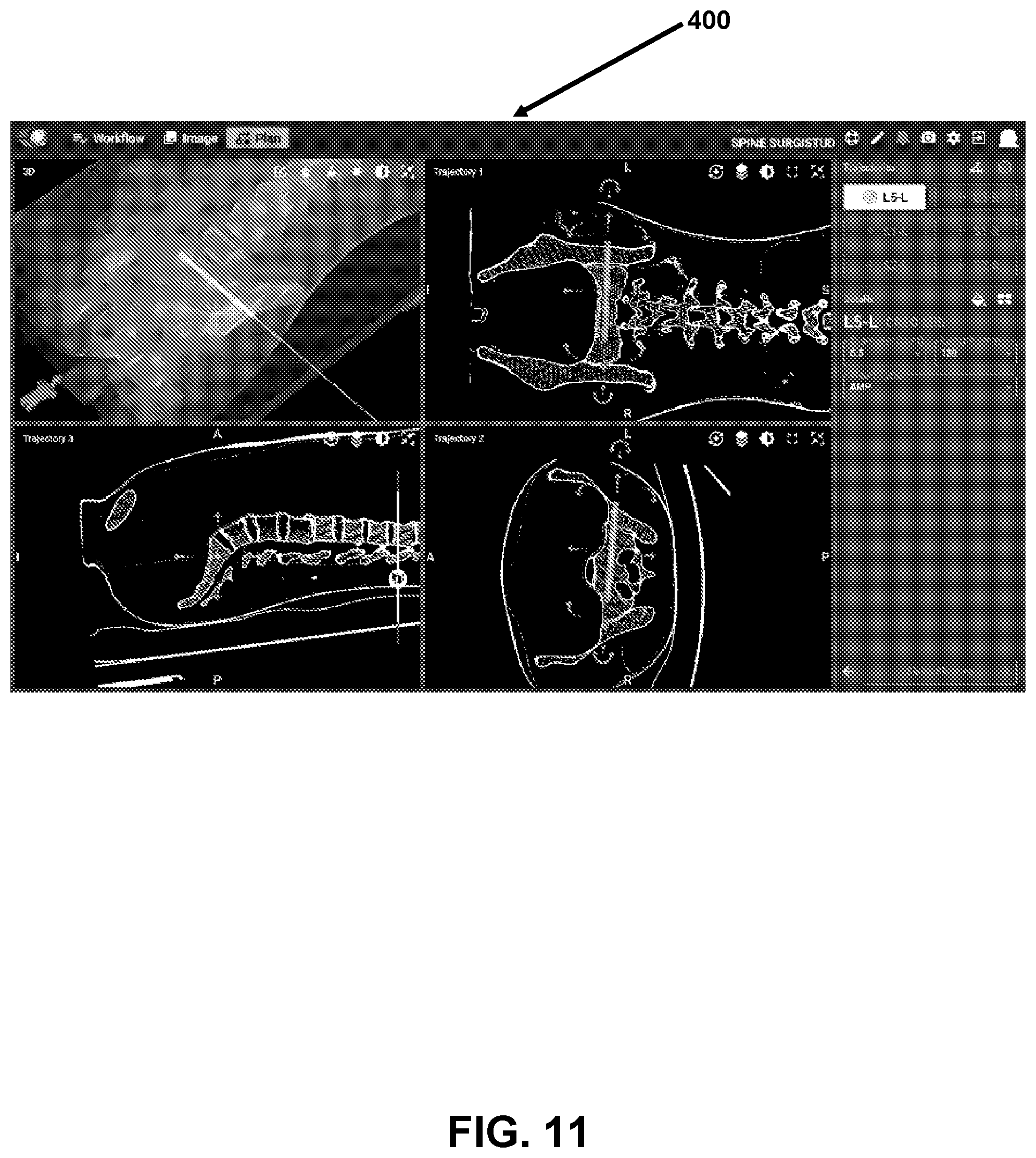 Patent US12426958 Figure 11 – Navigated pelvic implant system and associated method of use