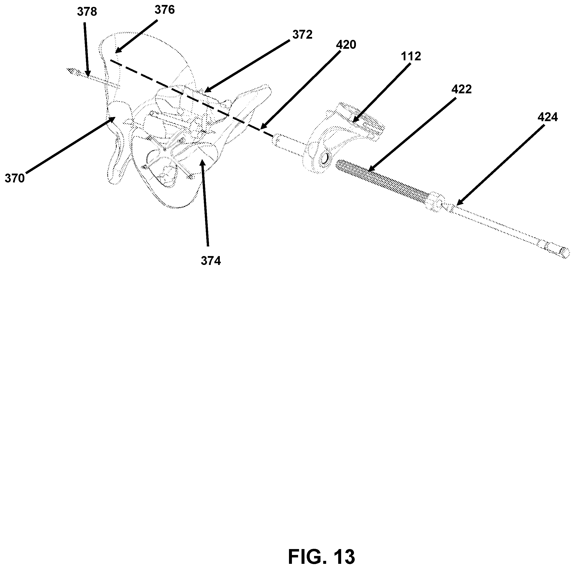 Patent US12426958 Figure 13 – Navigated pelvic implant system and associated method of use