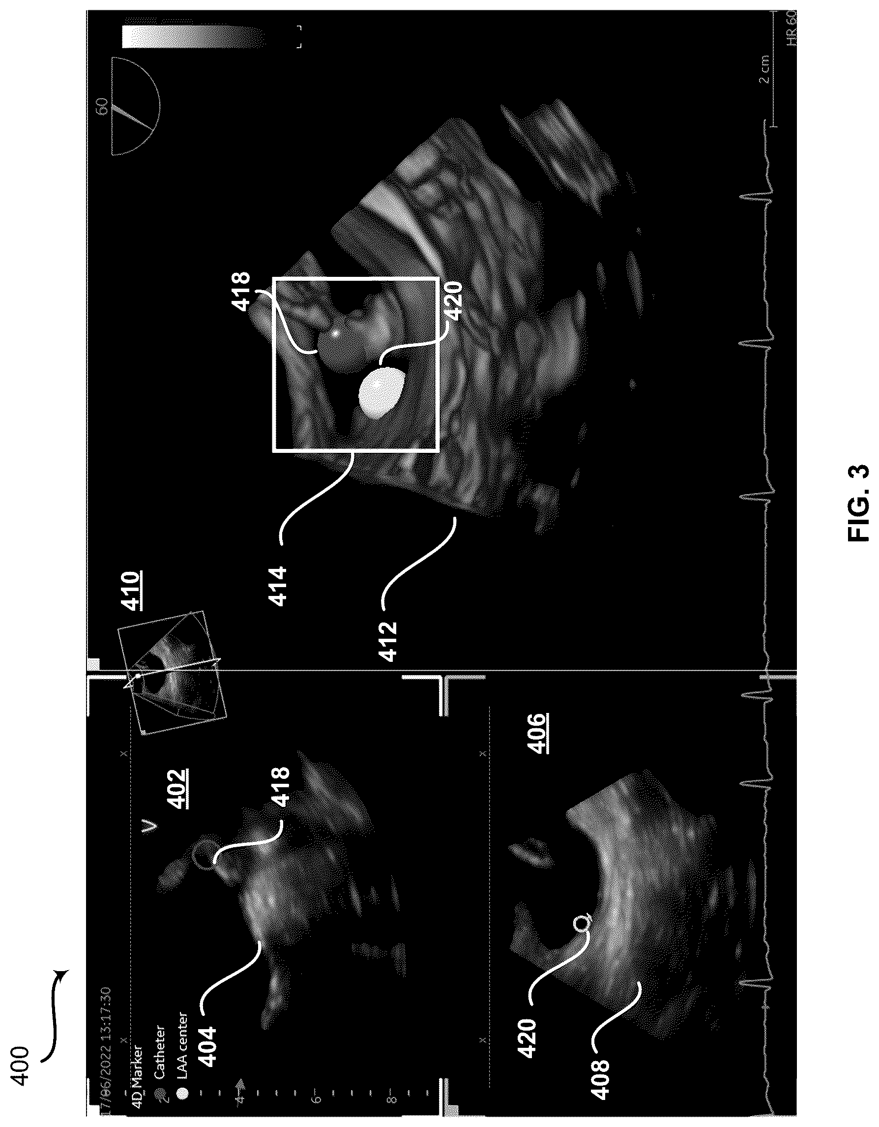 Patent US12426961 Figure 3 – System and method for automatic medical device placement in an anatomical structure using a locking mechanism