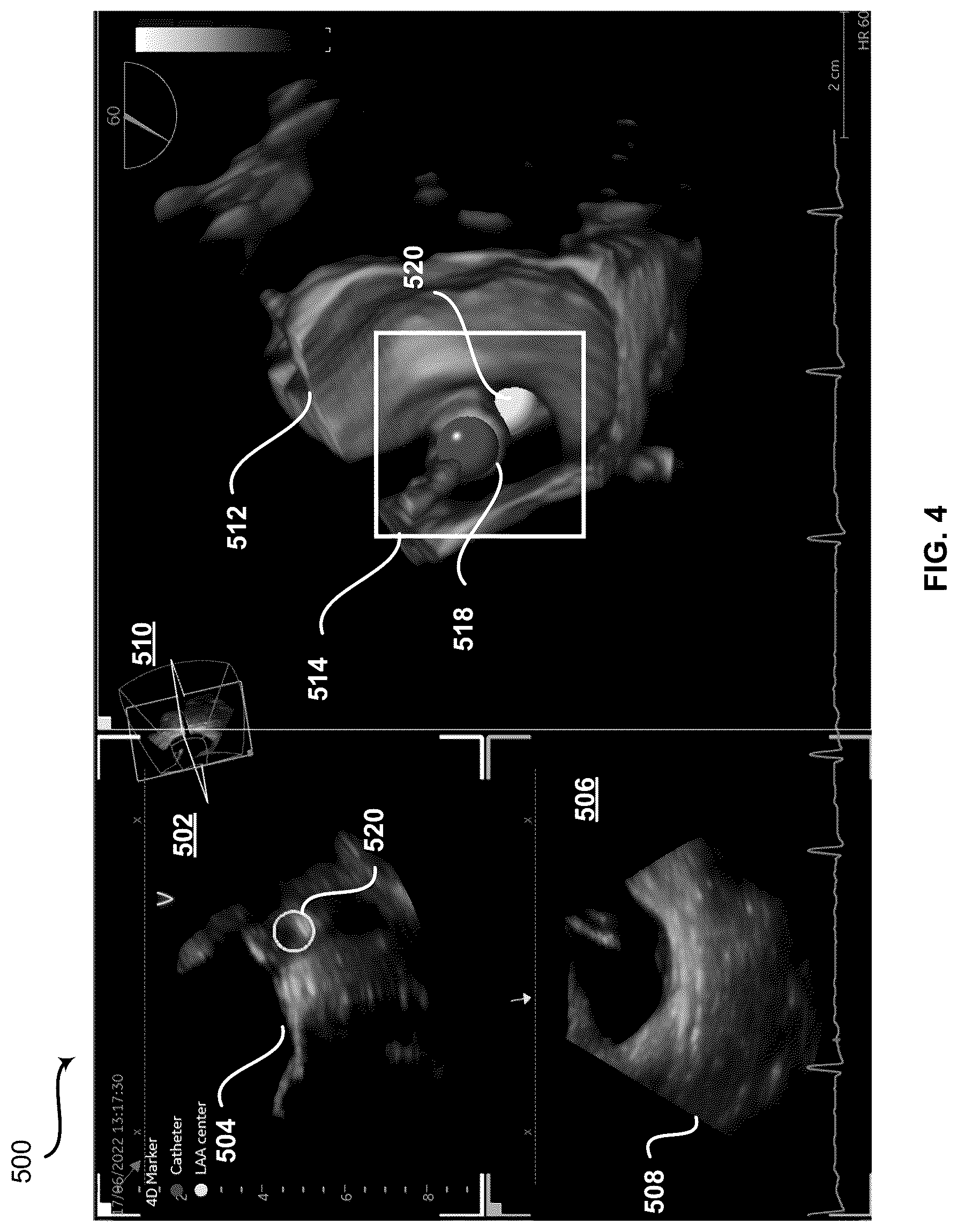 Patent US12426961 Figure 4 – System and method for automatic medical device placement in an anatomical structure using a locking mechanism