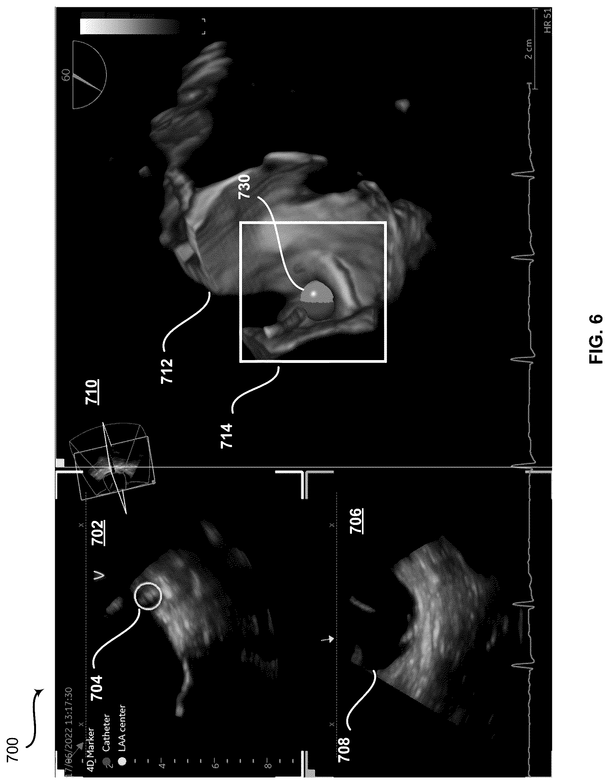 Patent US12426961 Figure 6 – System and method for automatic medical device placement in an anatomical structure using a locking mechanism