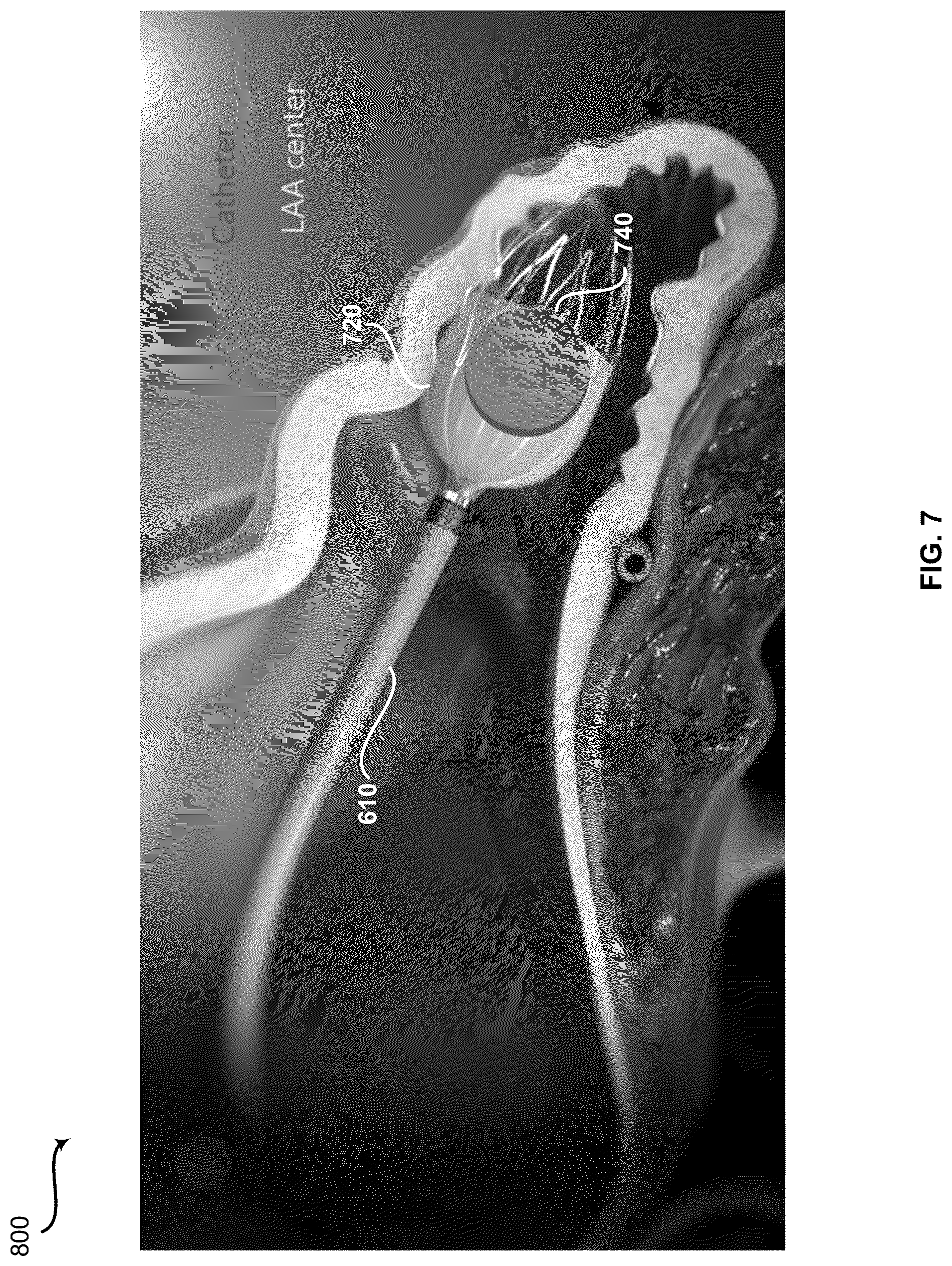 Patent US12426961 Figure 7 – System and method for automatic medical device placement in an anatomical structure using a locking mechanism