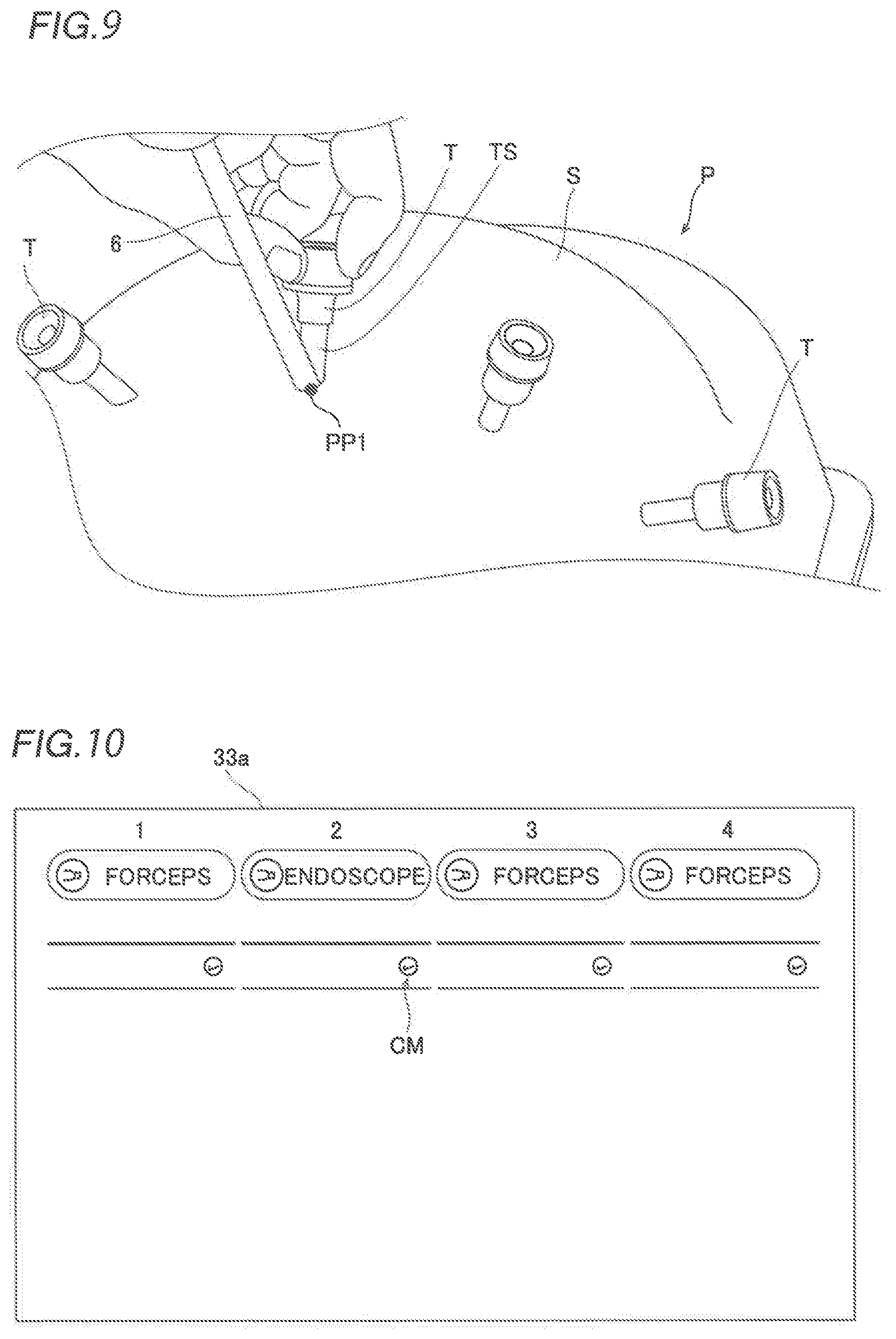 Patent US12426968 Figure 6 – Robotic surgical system and method for setting pivot position