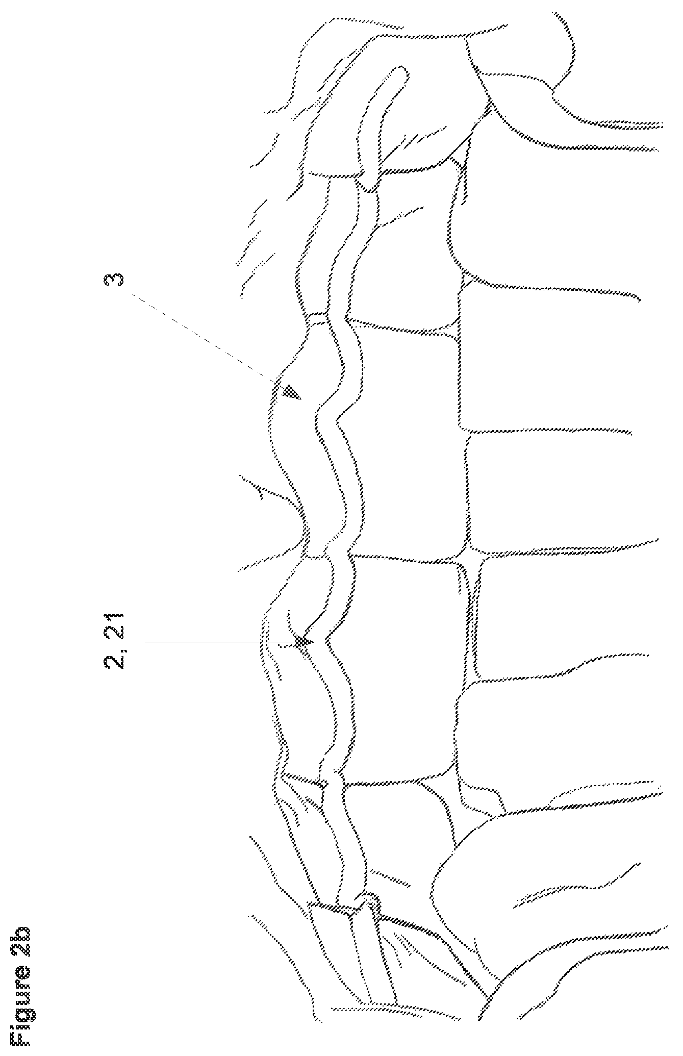 Patent US12426988 Figure 3 – Three-dimensional orthodontic retainer and method for making a three-dimensional orthodontic retainer