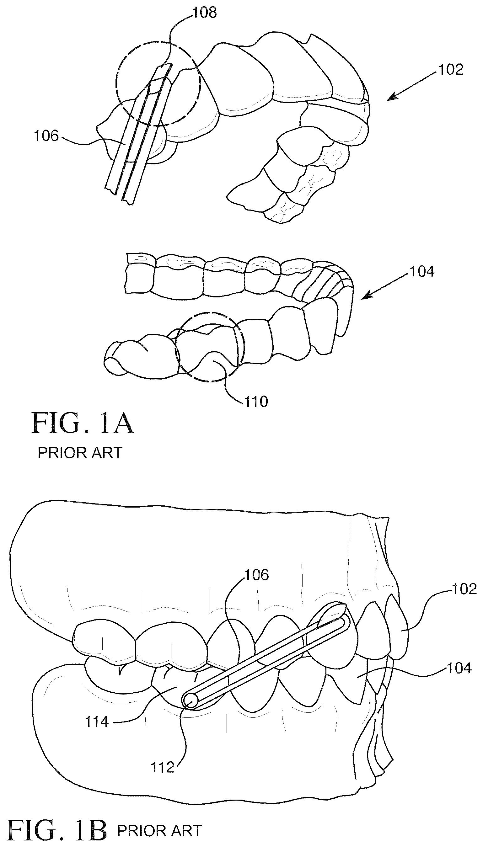 Patent US12426993 Figure 1 – Orthodontic aligner with built-in hook or traction device