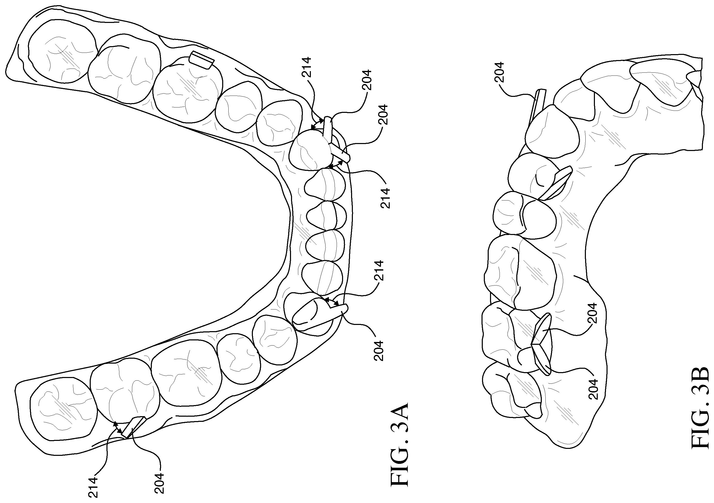 Patent US12426993 Figure 3 – Orthodontic aligner with built-in hook or traction device