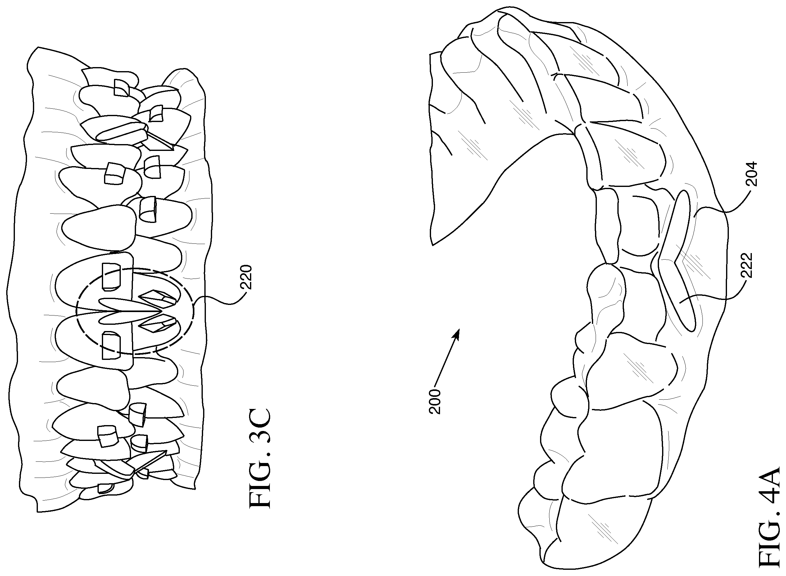 Patent US12426993 Figure 4 – Orthodontic aligner with built-in hook or traction device