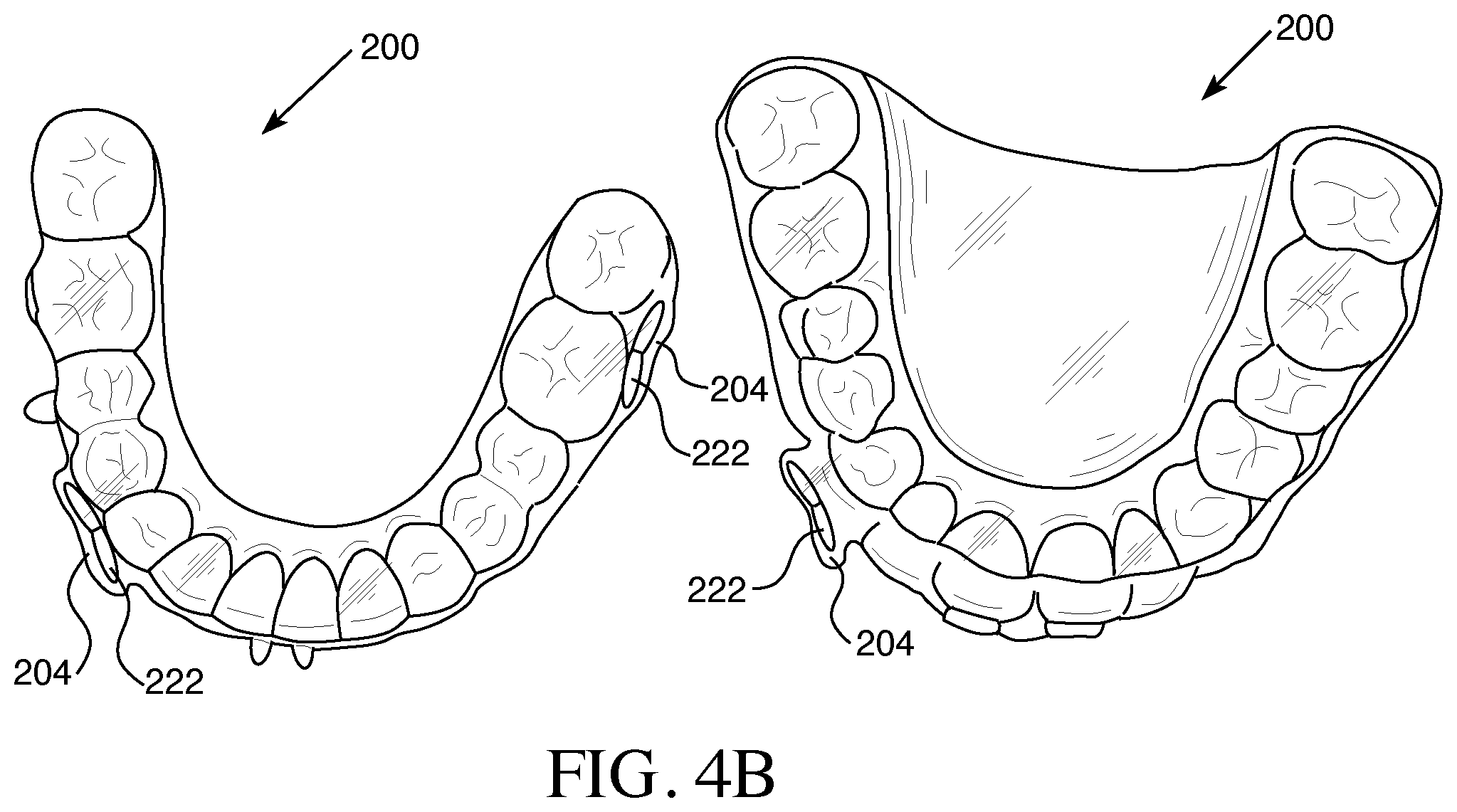 Patent US12426993 Figure 5 – Orthodontic aligner with built-in hook or traction device