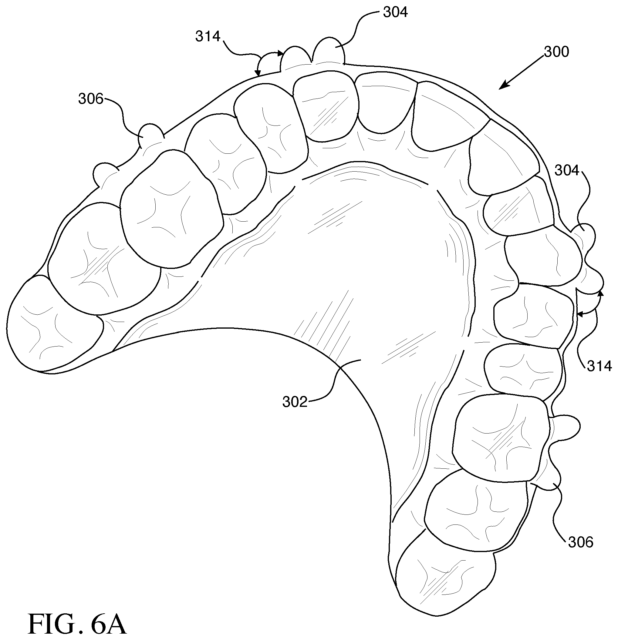 Patent US12426993 Figure 7 – Orthodontic aligner with built-in hook or traction device