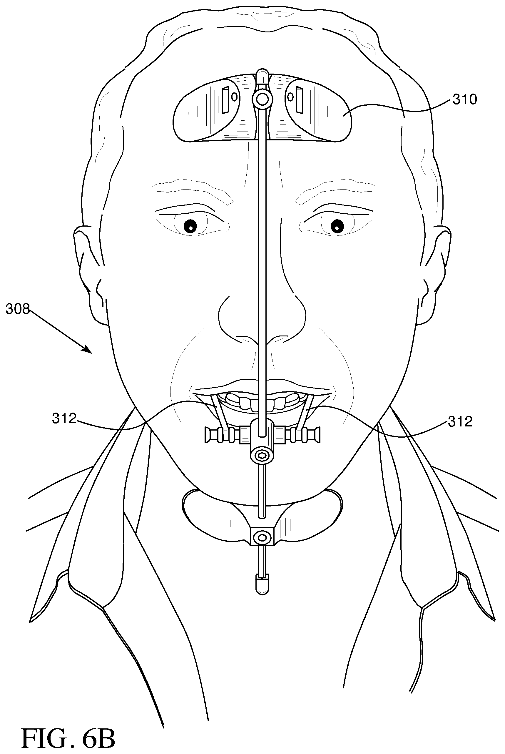 Patent US12426993 Figure 8 – Orthodontic aligner with built-in hook or traction device