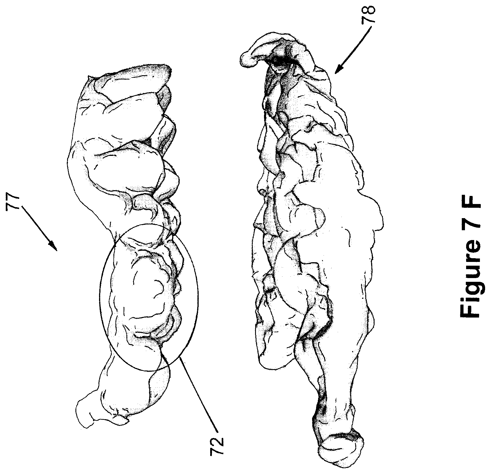 Patent US12426994 Figure 15 – Methods for generating dental models and appliances