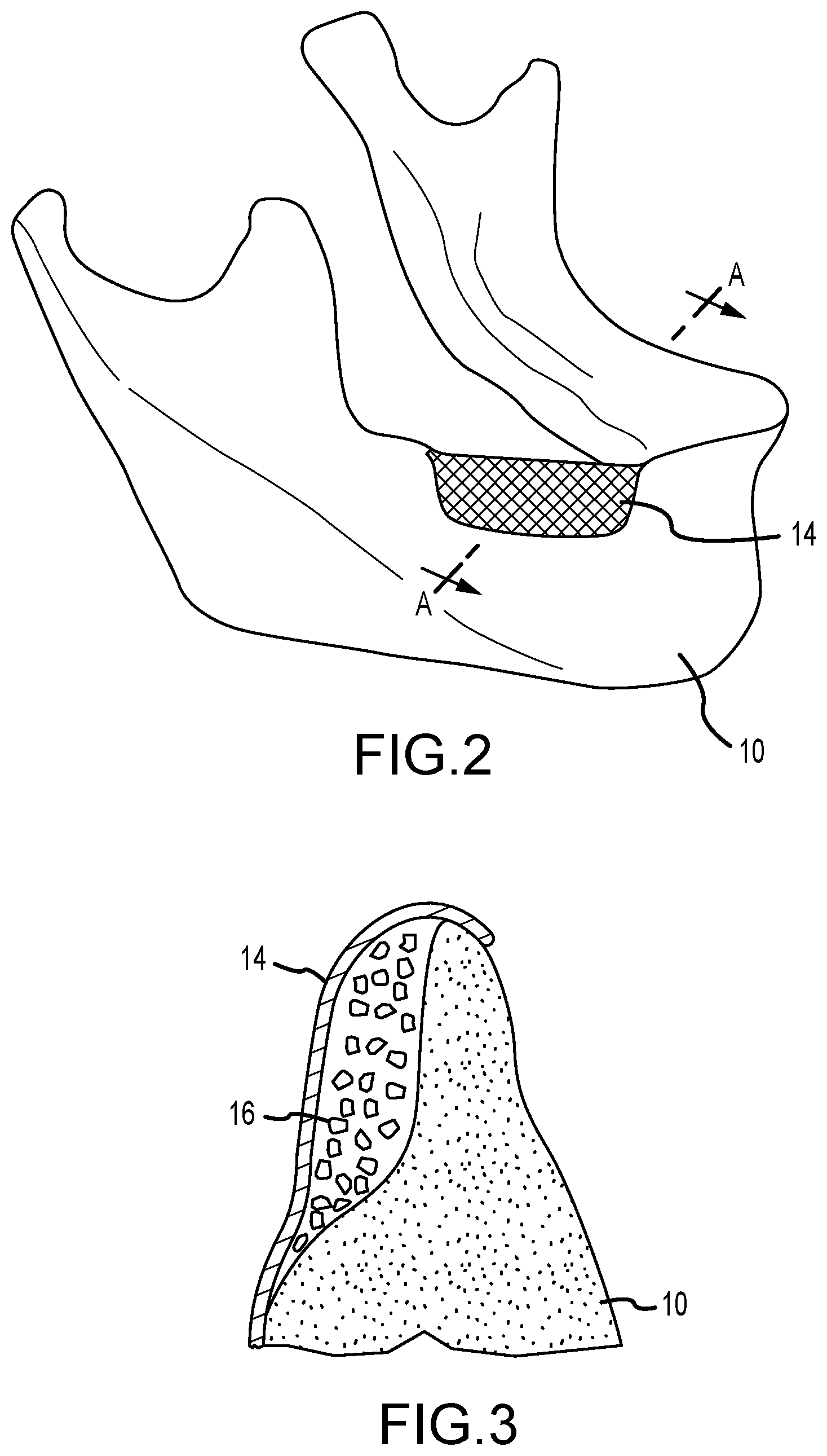 Patent US12426996 Figure 2 – Dental membrane