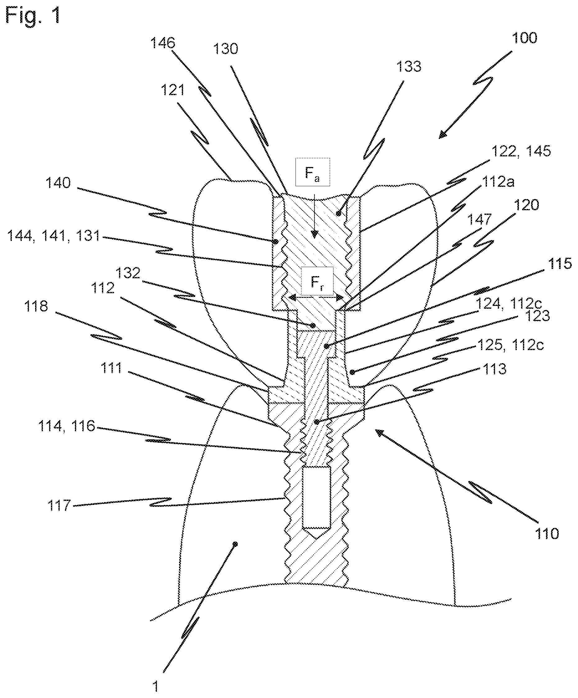 Patent US12426997 Figure 1 – Dental replacement having a connecting sleeve