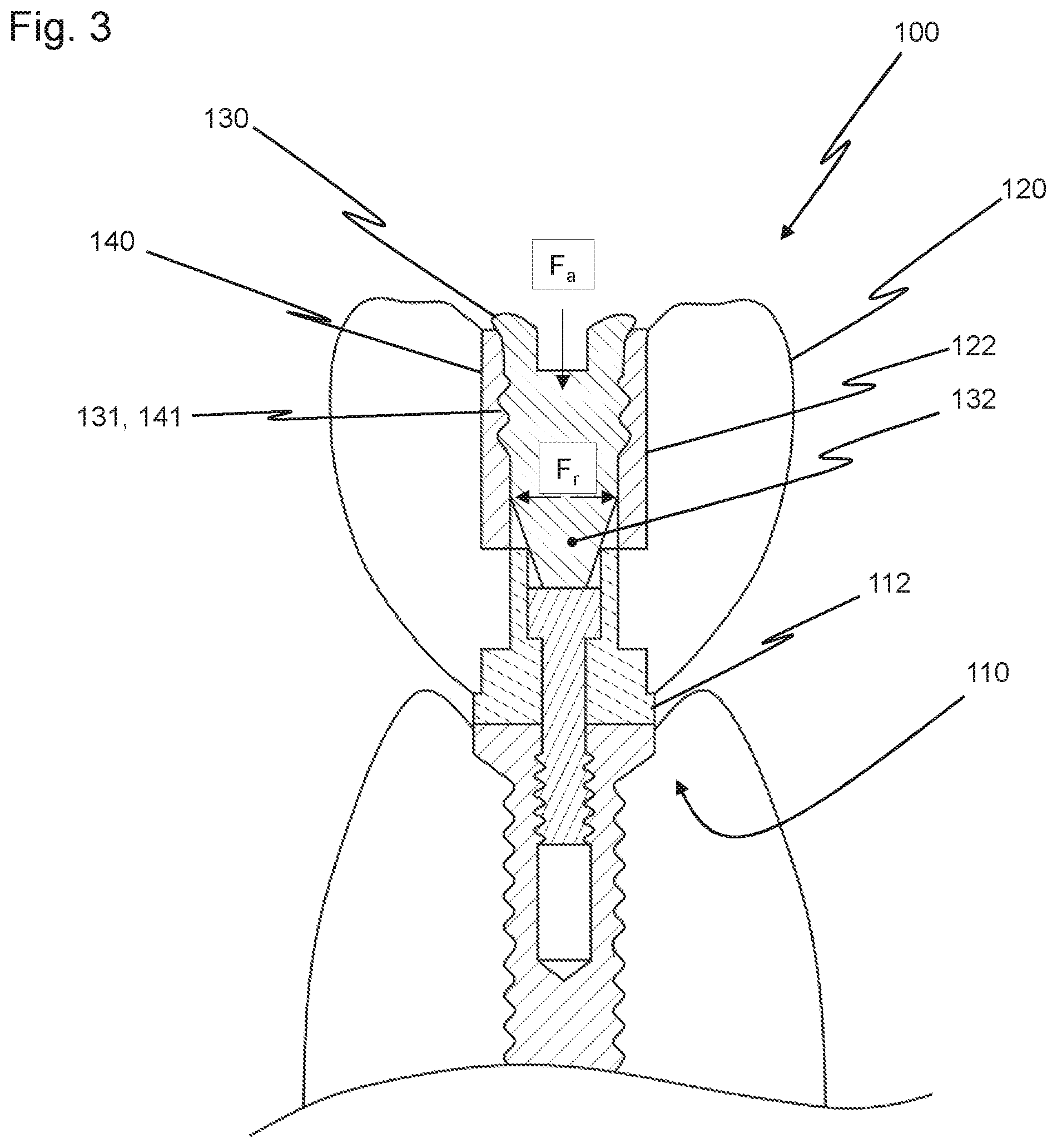Patent US12426997 Figure 3 – Dental replacement having a connecting sleeve