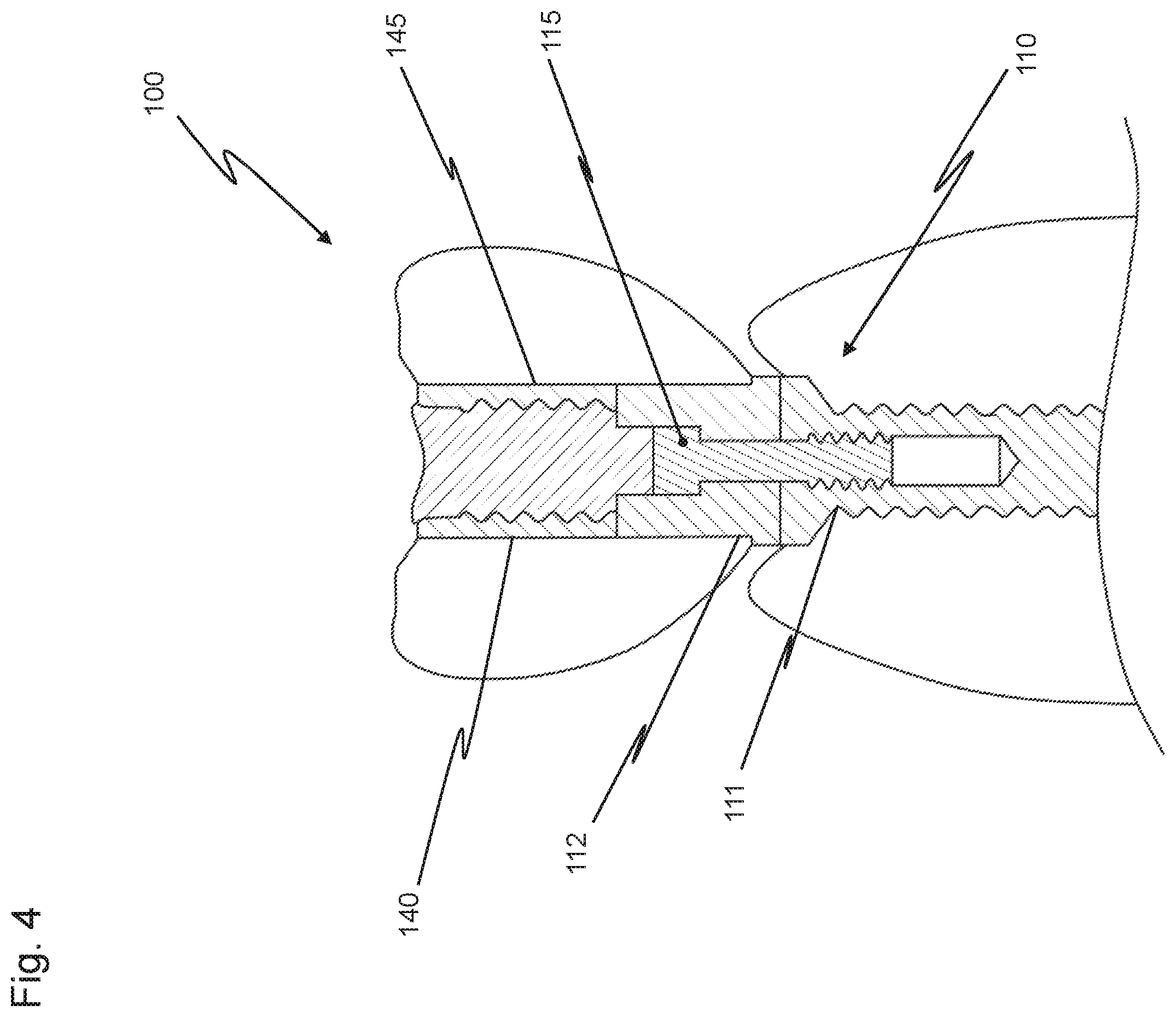 Patent US12426997 Figure 4 – Dental replacement having a connecting sleeve