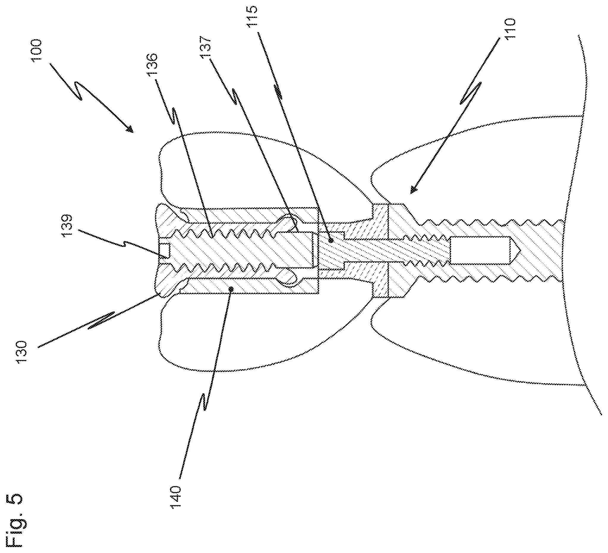 Patent US12426997 Figure 5 – Dental replacement having a connecting sleeve