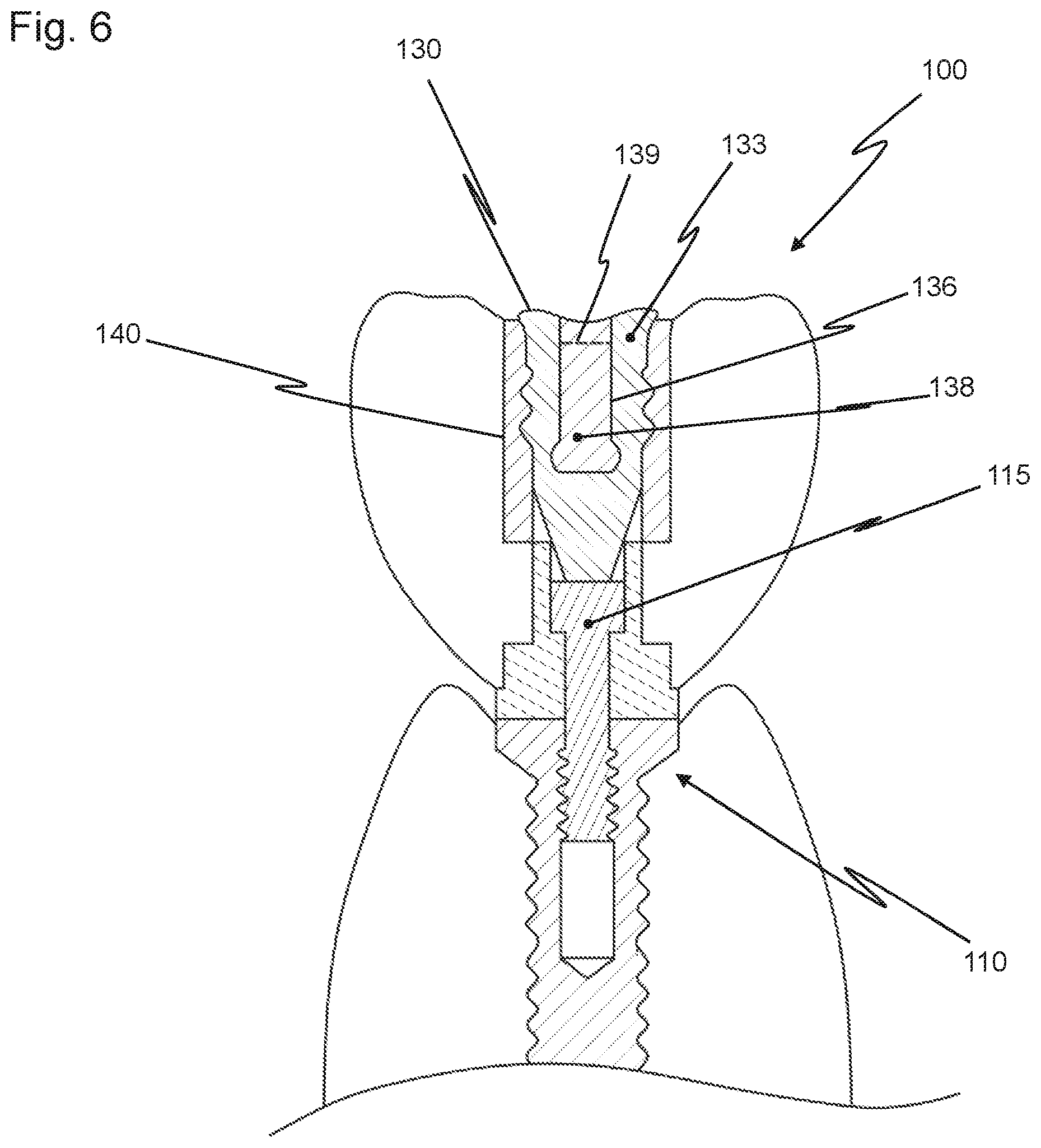 Patent US12426997 Figure 6 – Dental replacement having a connecting sleeve