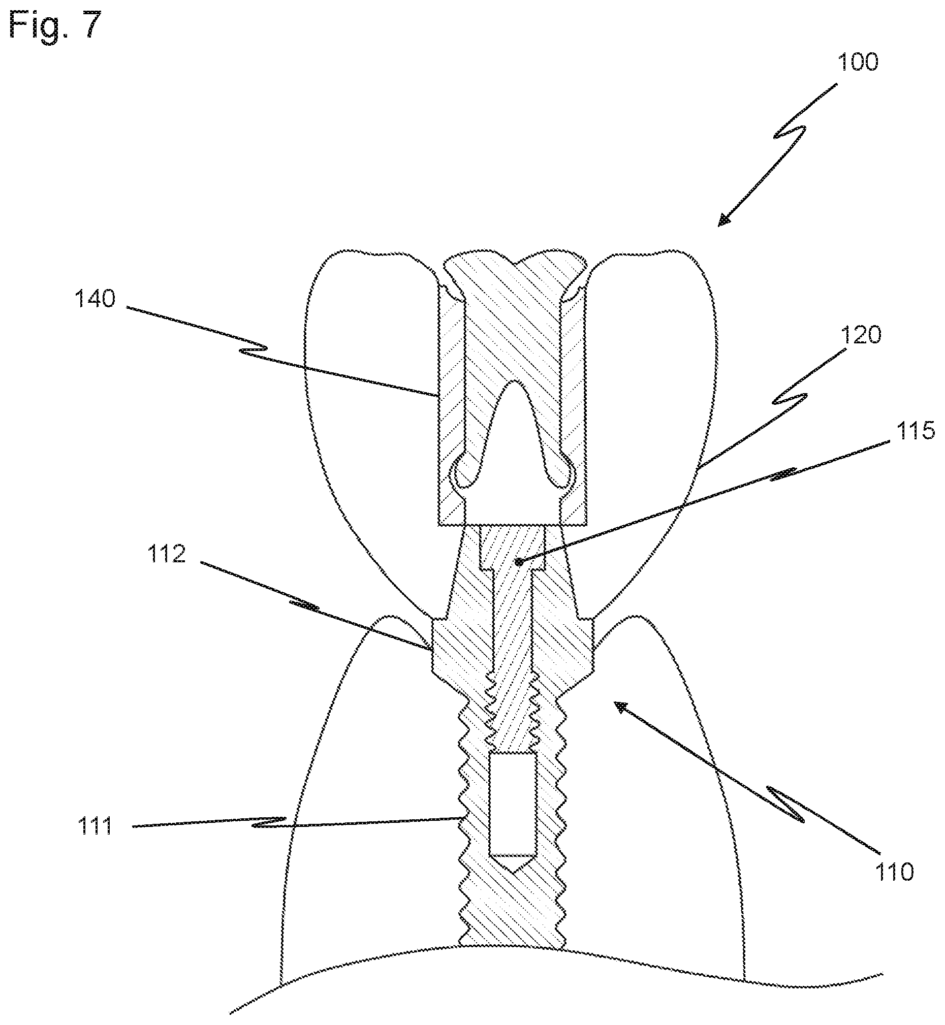 Patent US12426997 Figure 7 – Dental replacement having a connecting sleeve