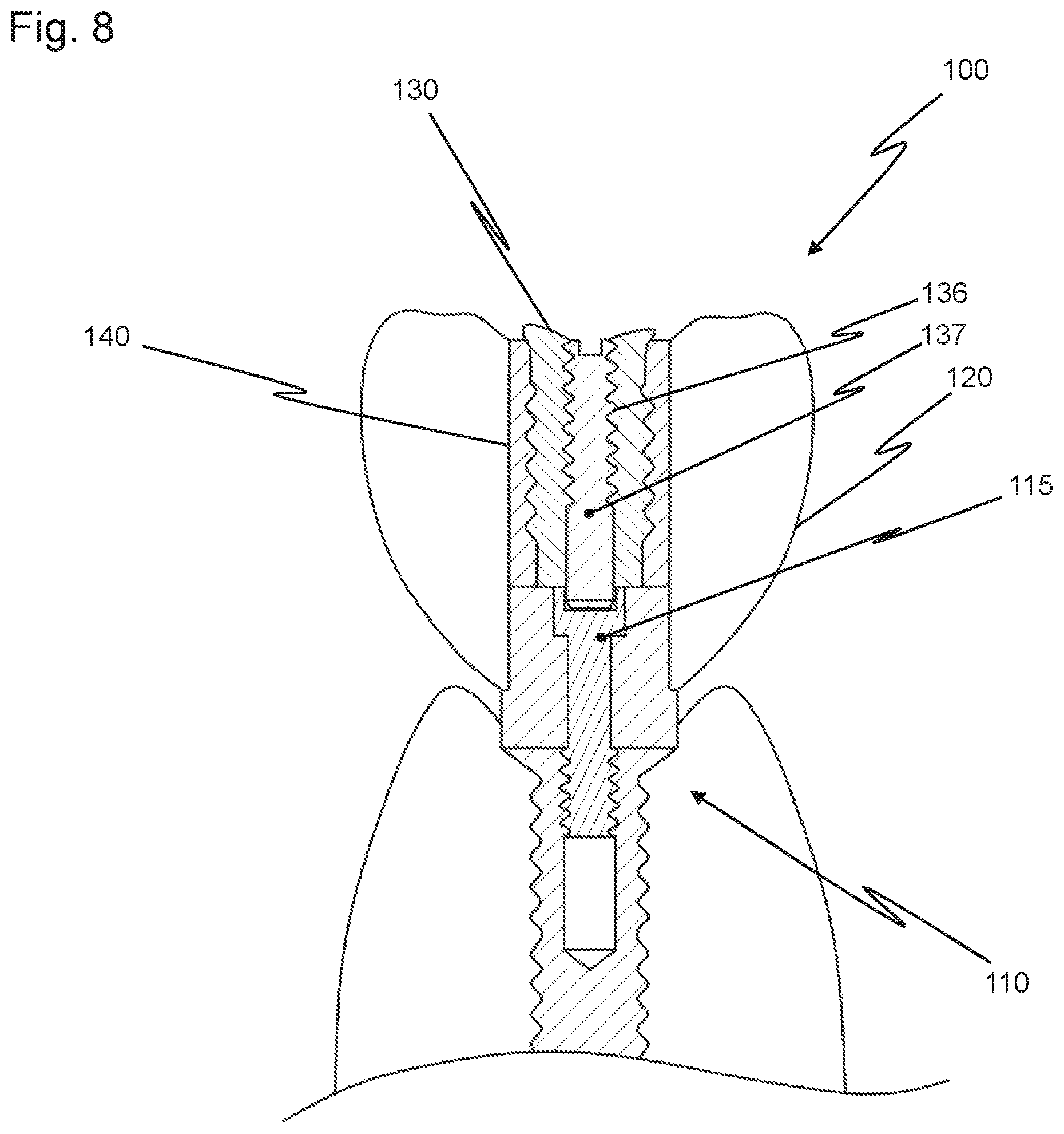 Patent US12426997 Figure 8 – Dental replacement having a connecting sleeve