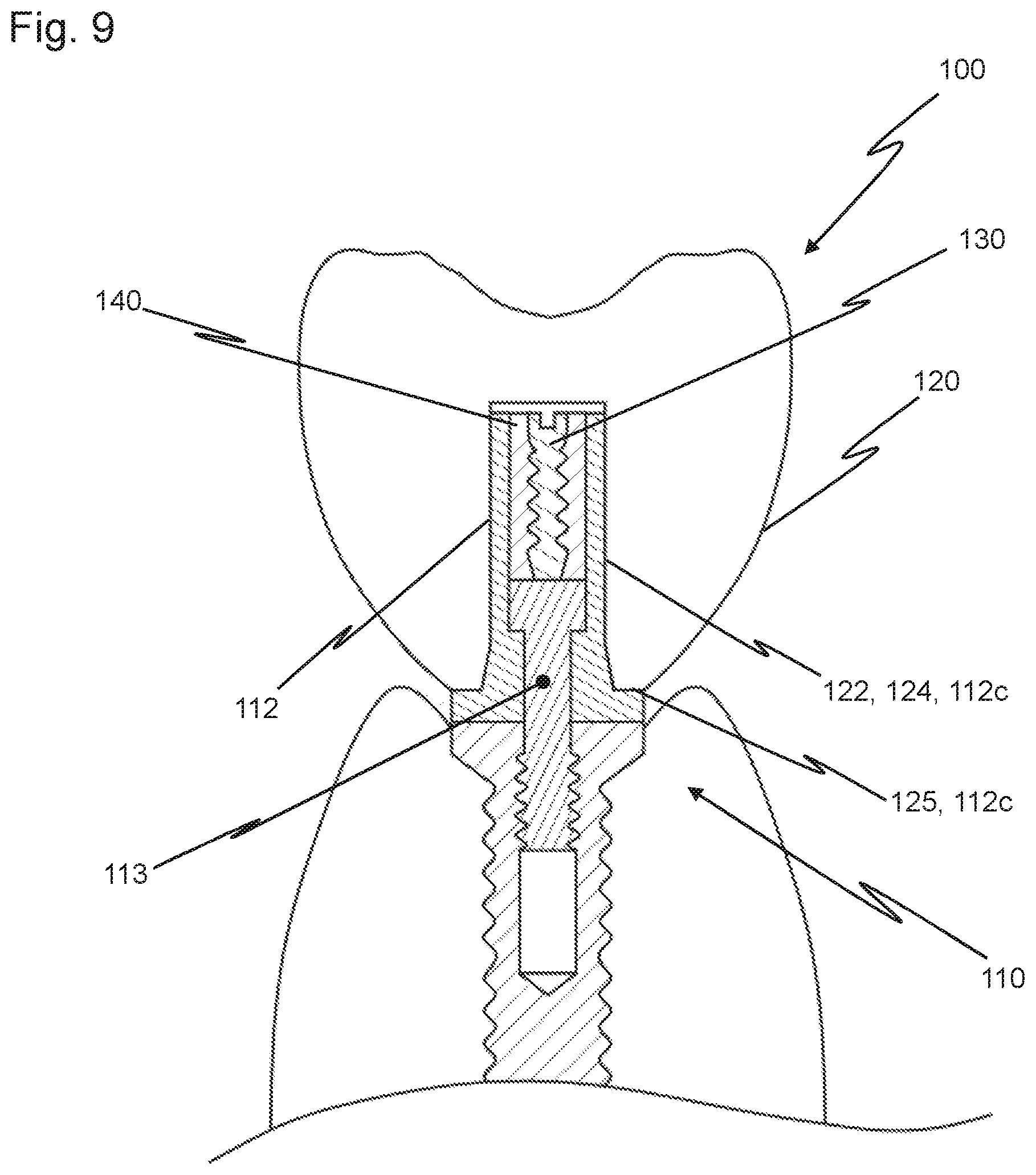 Patent US12426997 Figure 9 – Dental replacement having a connecting sleeve