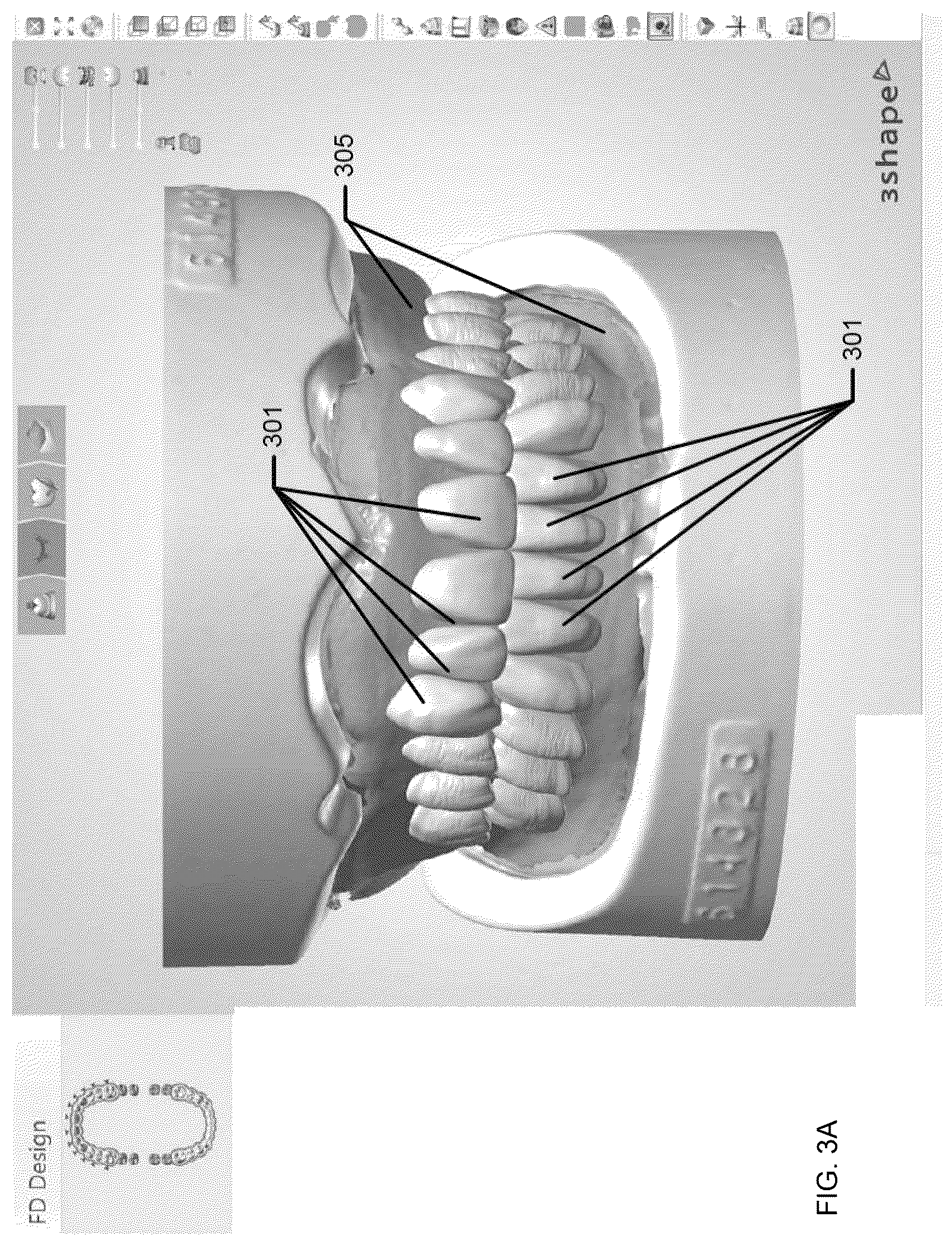 Patent US12426998 Figure 5 – Snapping of denture teeth