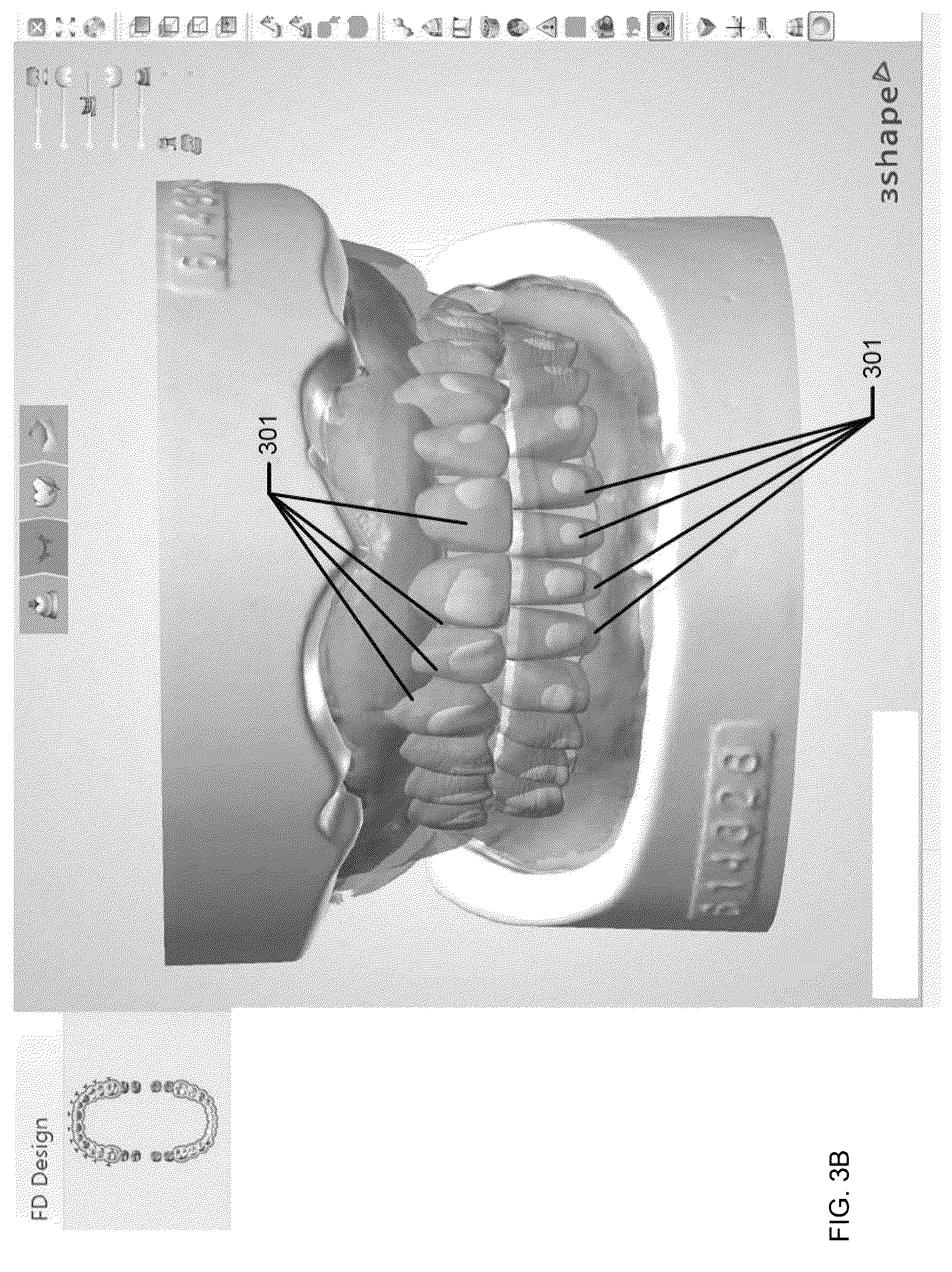 Patent US12426998 Figure 6 – Snapping of denture teeth