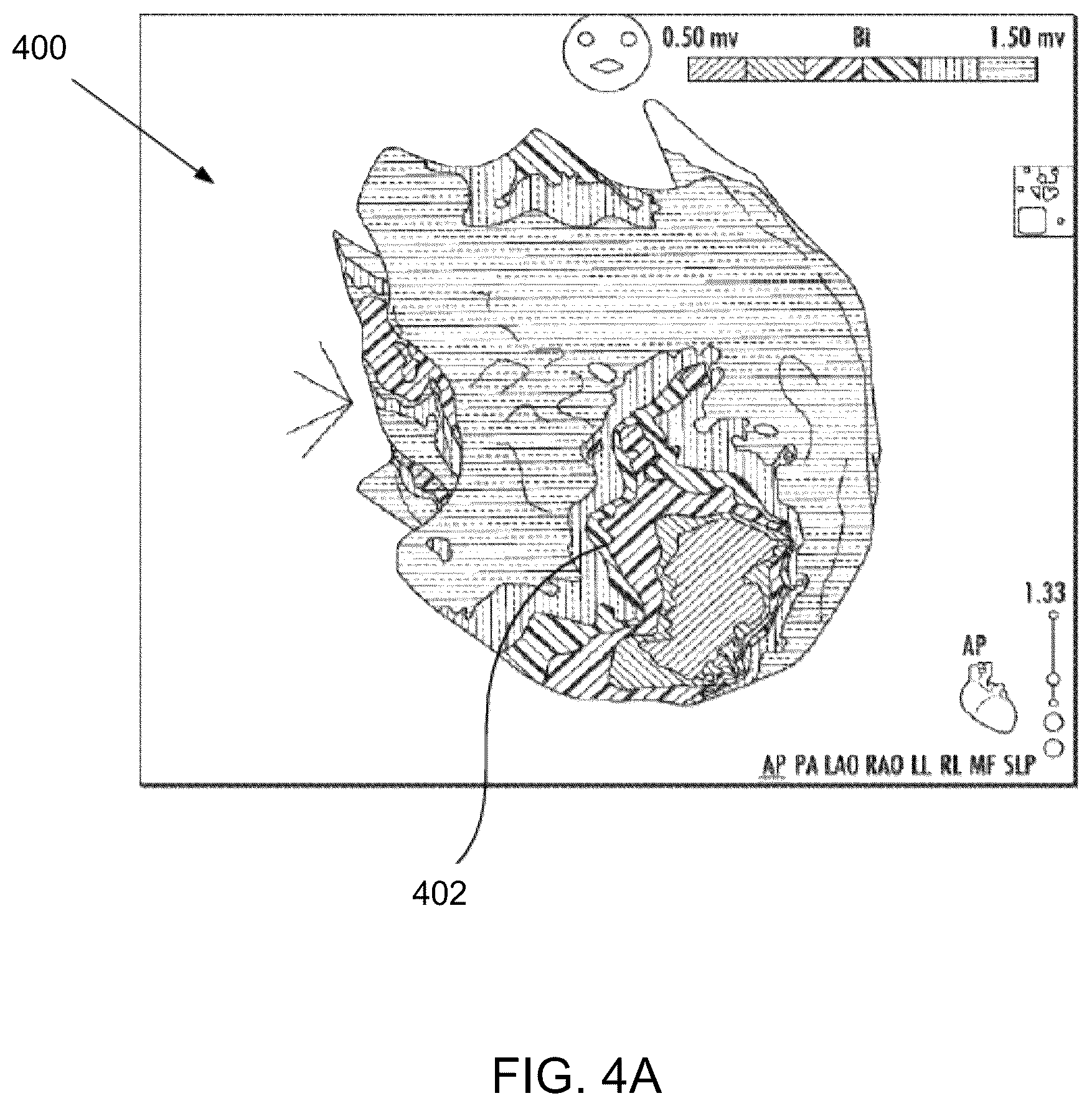 Patent US12437466 Figure 4 – Using signed distance functions to visualize pulsed field ablation (PFA) tags