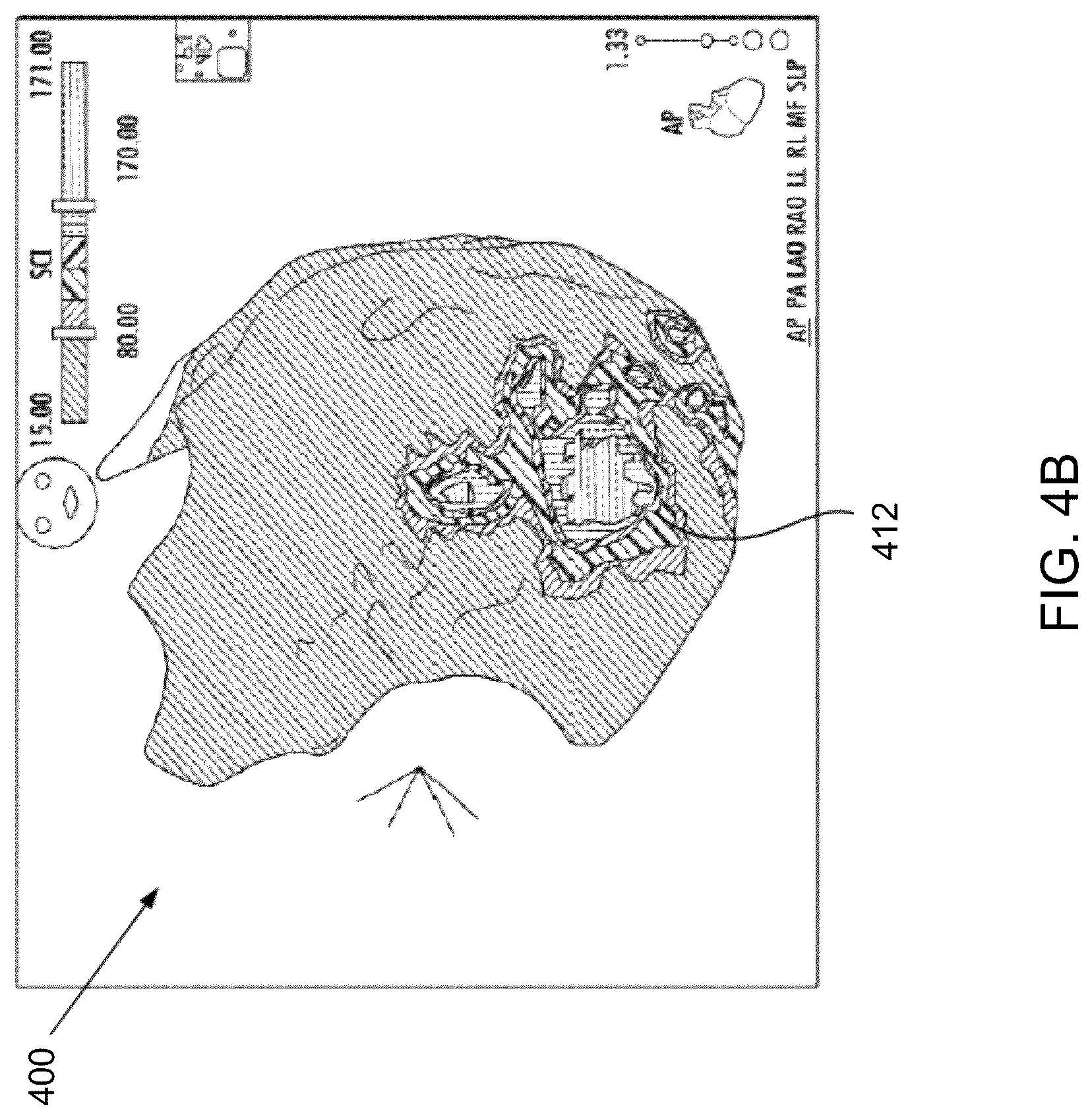 Patent US12437466 Figure 5 – Using signed distance functions to visualize pulsed field ablation (PFA) tags