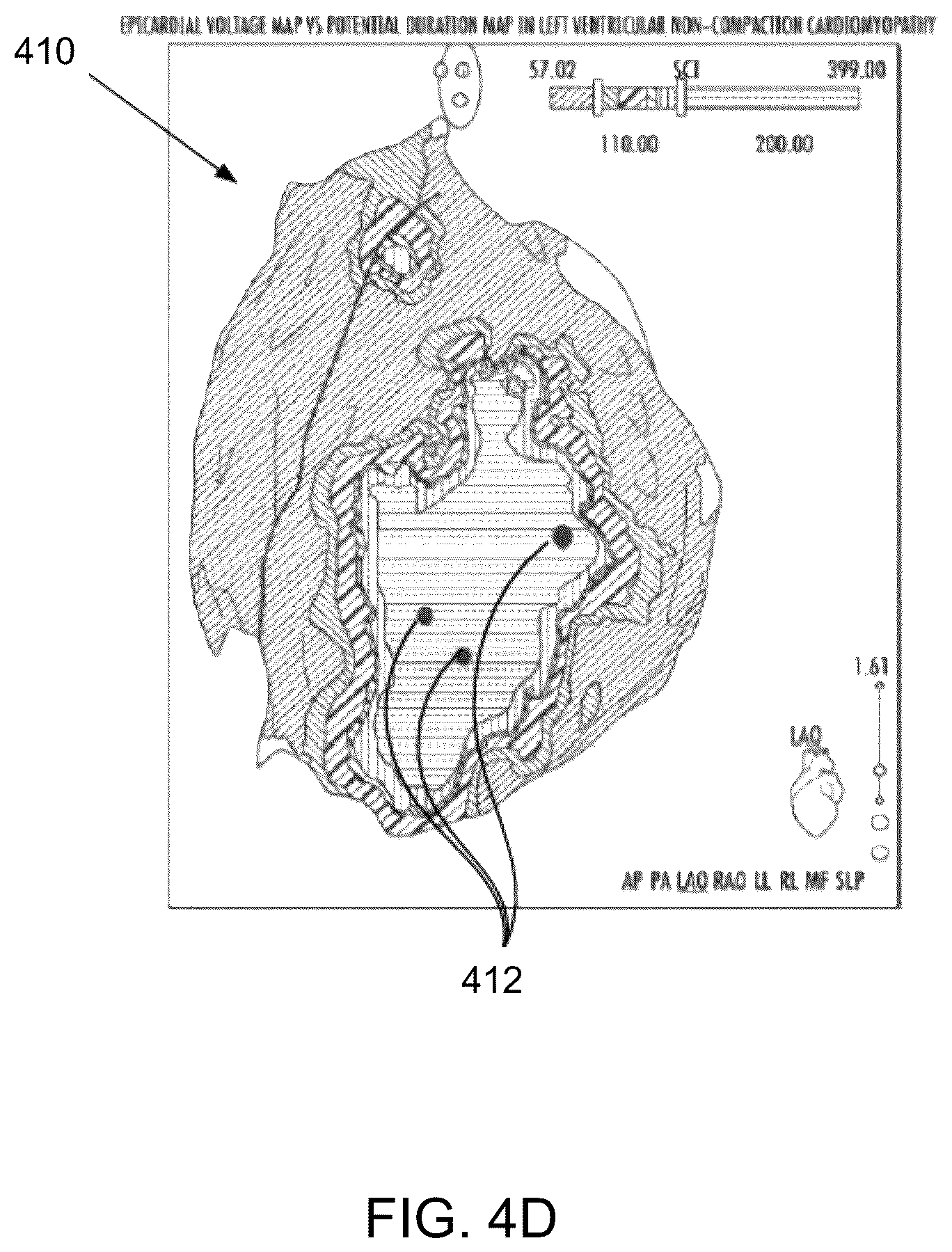 Patent US12437466 Figure 7 – Using signed distance functions to visualize pulsed field ablation (PFA) tags