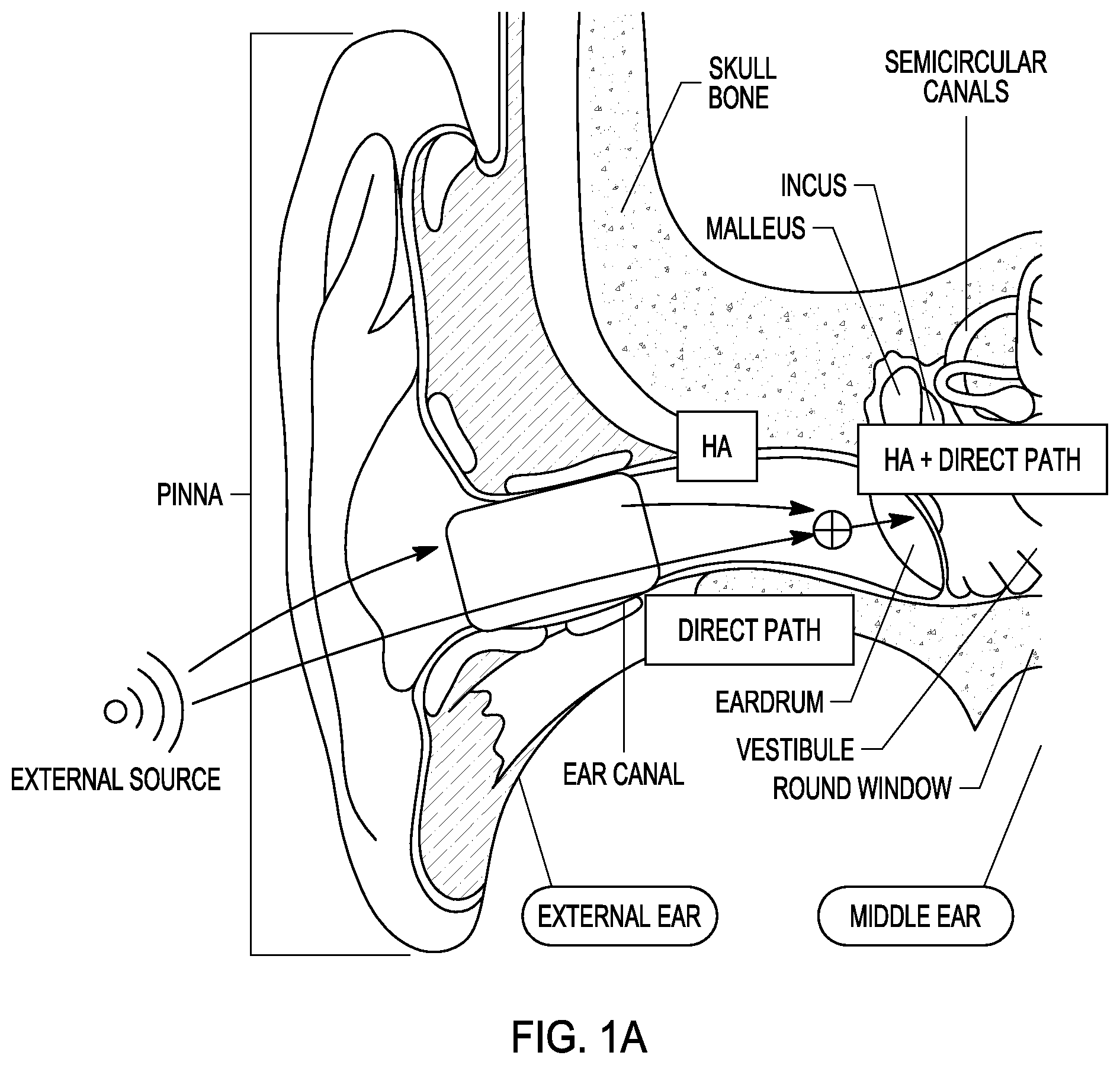 Patent US12445786 Figure 1 – Active noise control for sound quality in hearing devices