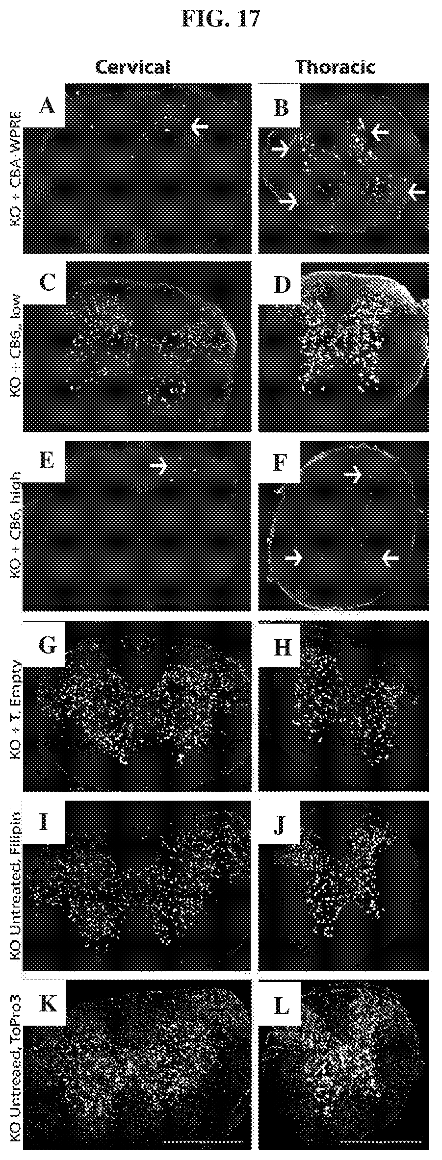 Patent US12448629 Figure 17 – rAAV vectors for the treatment of GM1 and GM2 gangliosidosis