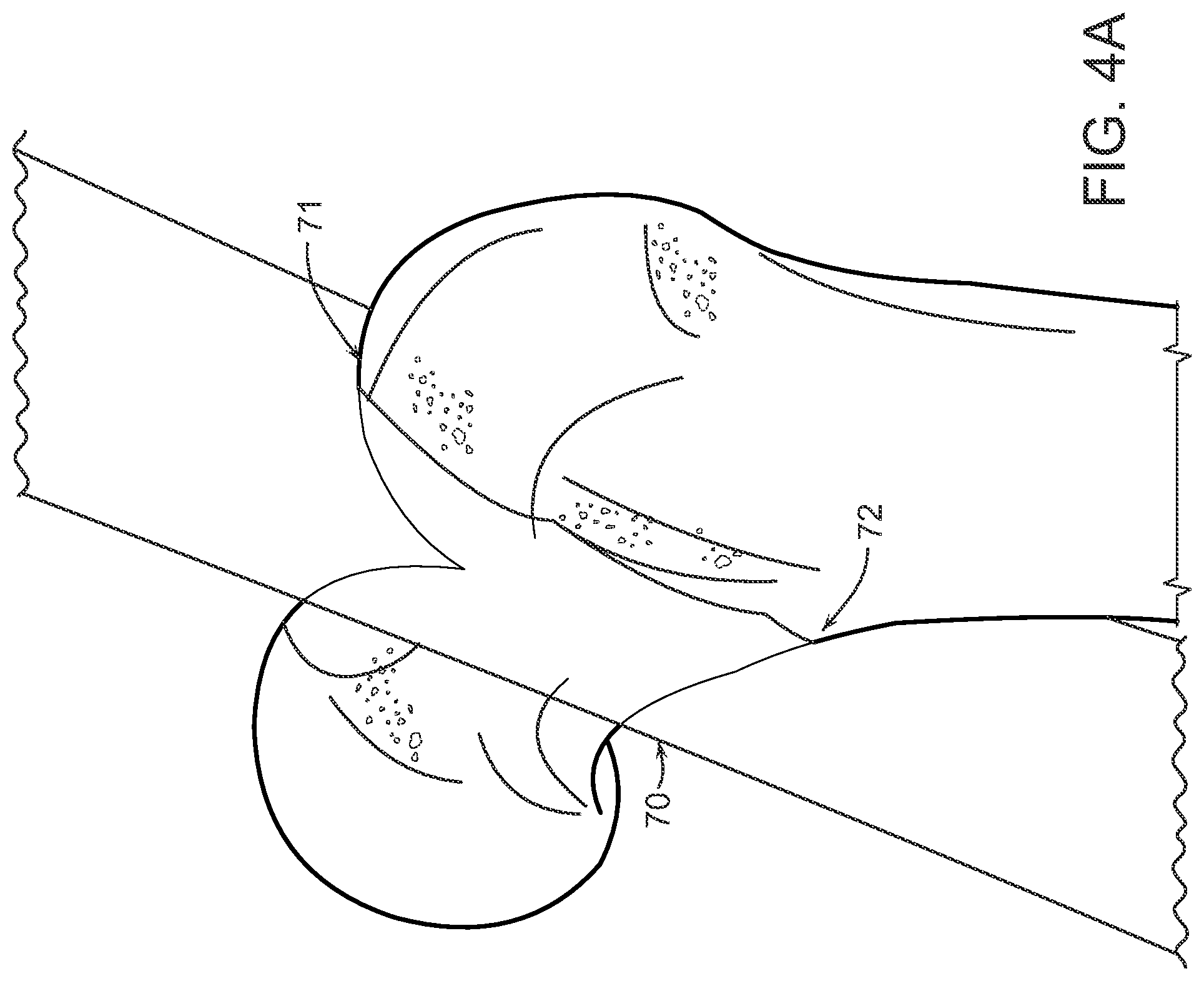 Patent US12472000 Figure 4 – Augmented reality system for monitoring size and laterality of physical implants during surgery and for billing and invoicing