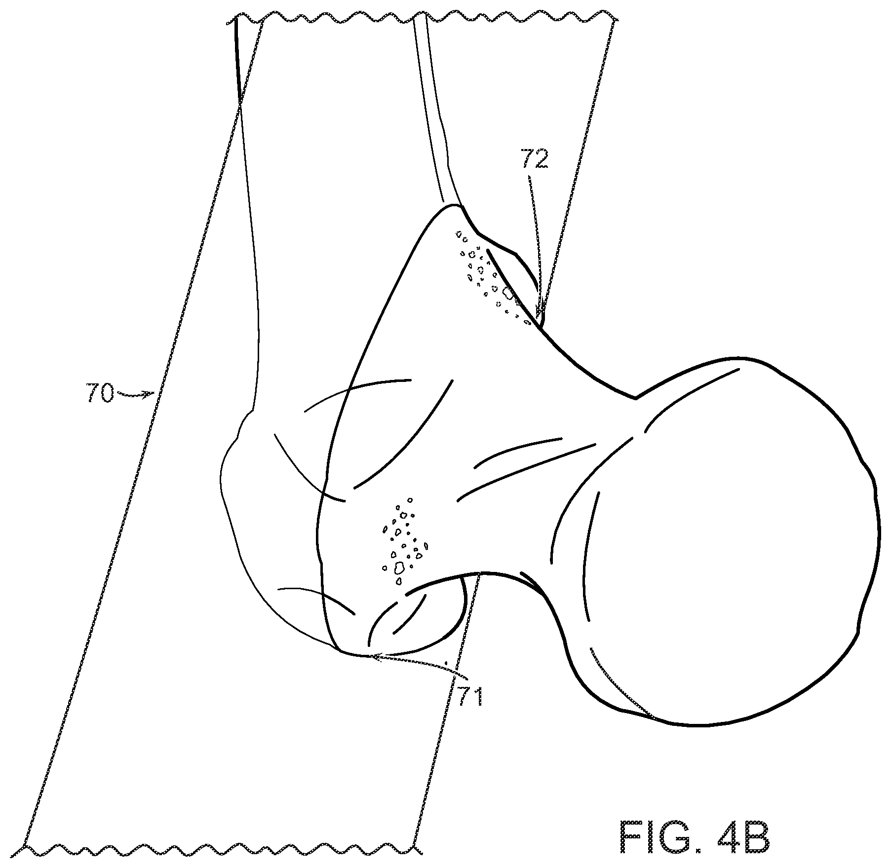 Patent US12472000 Figure 5 – Augmented reality system for monitoring size and laterality of physical implants during surgery and for billing and invoicing