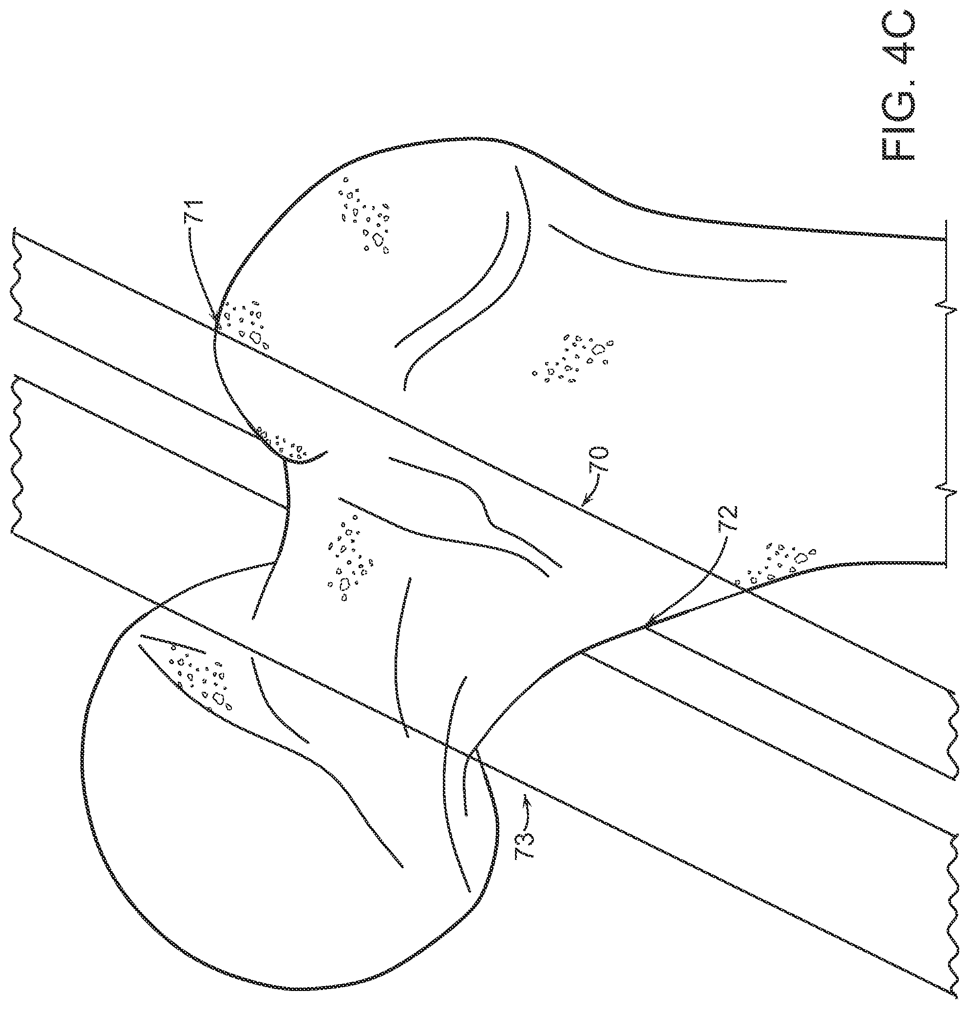 Patent US12472000 Figure 6 – Augmented reality system for monitoring size and laterality of physical implants during surgery and for billing and invoicing