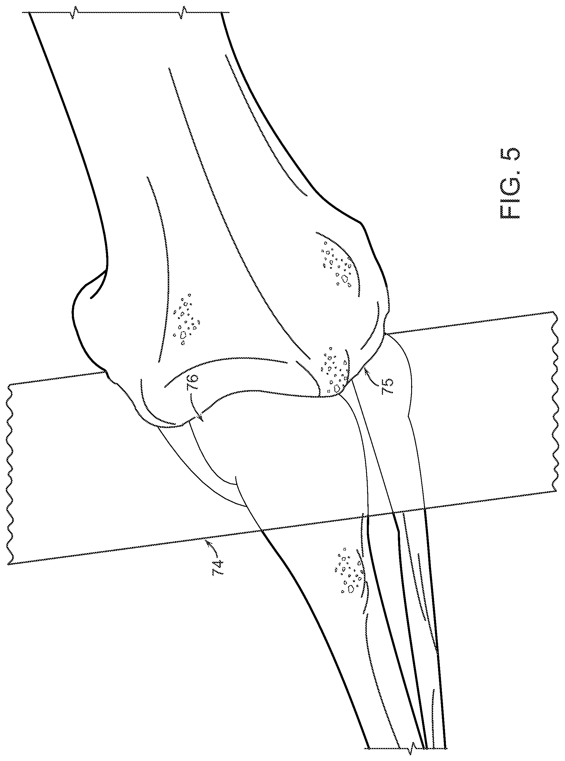 Patent US12472000 Figure 7 – Augmented reality system for monitoring size and laterality of physical implants during surgery and for billing and invoicing