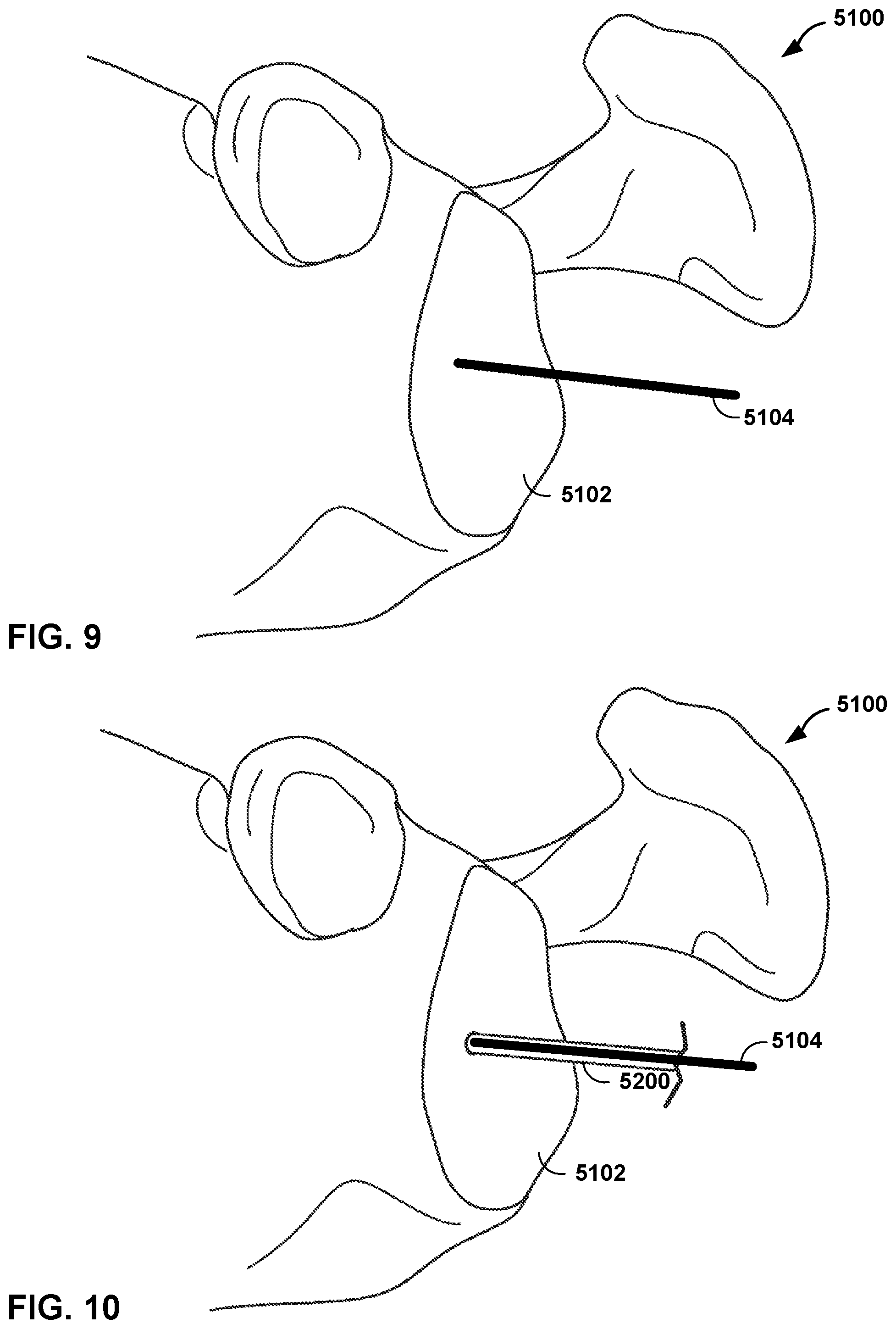 Patent US12472013 Figure 8 – Virtual guidance for correcting surgical pin installation