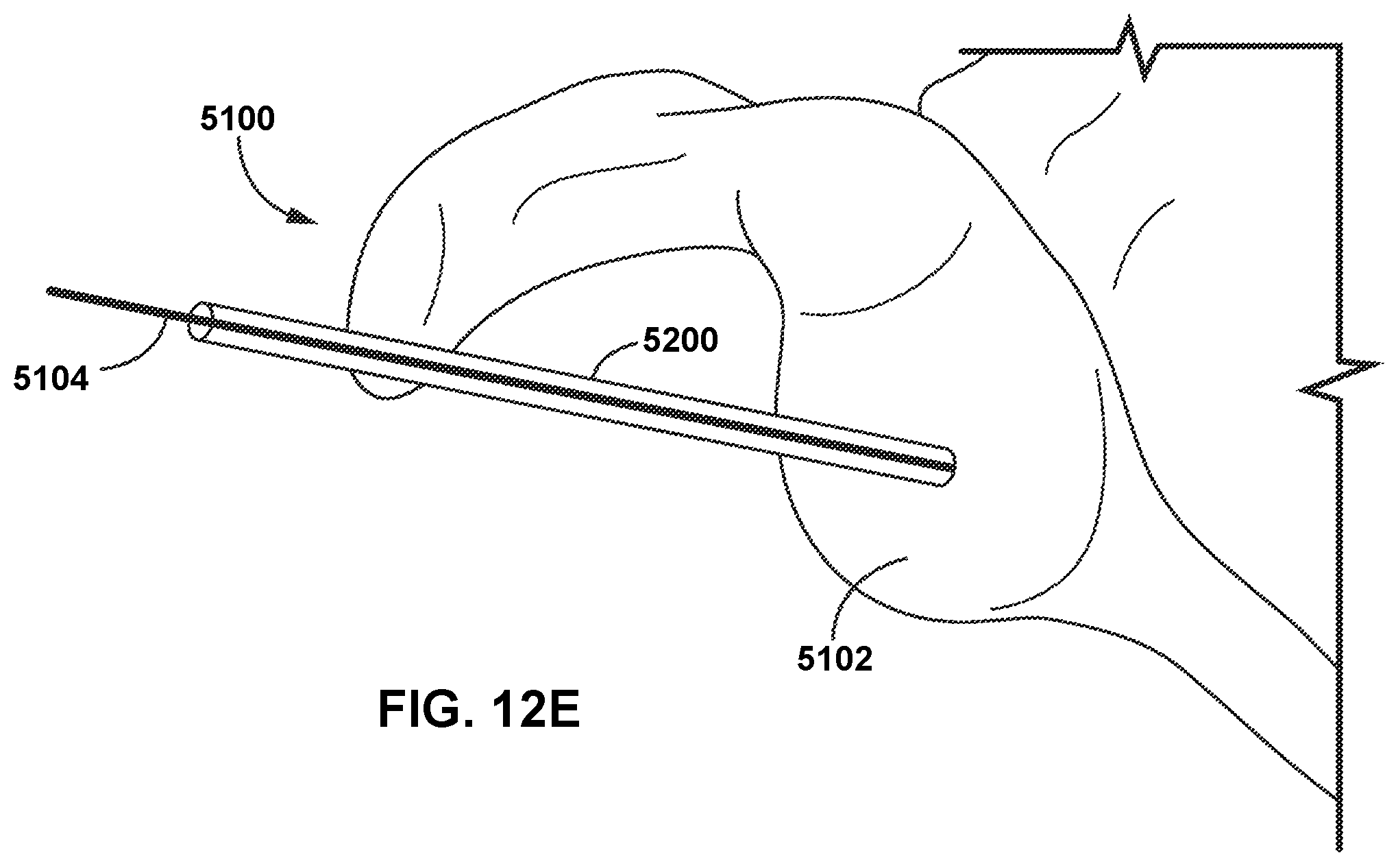 Patent US12472013 Figure 12 – Virtual guidance for correcting surgical pin installation