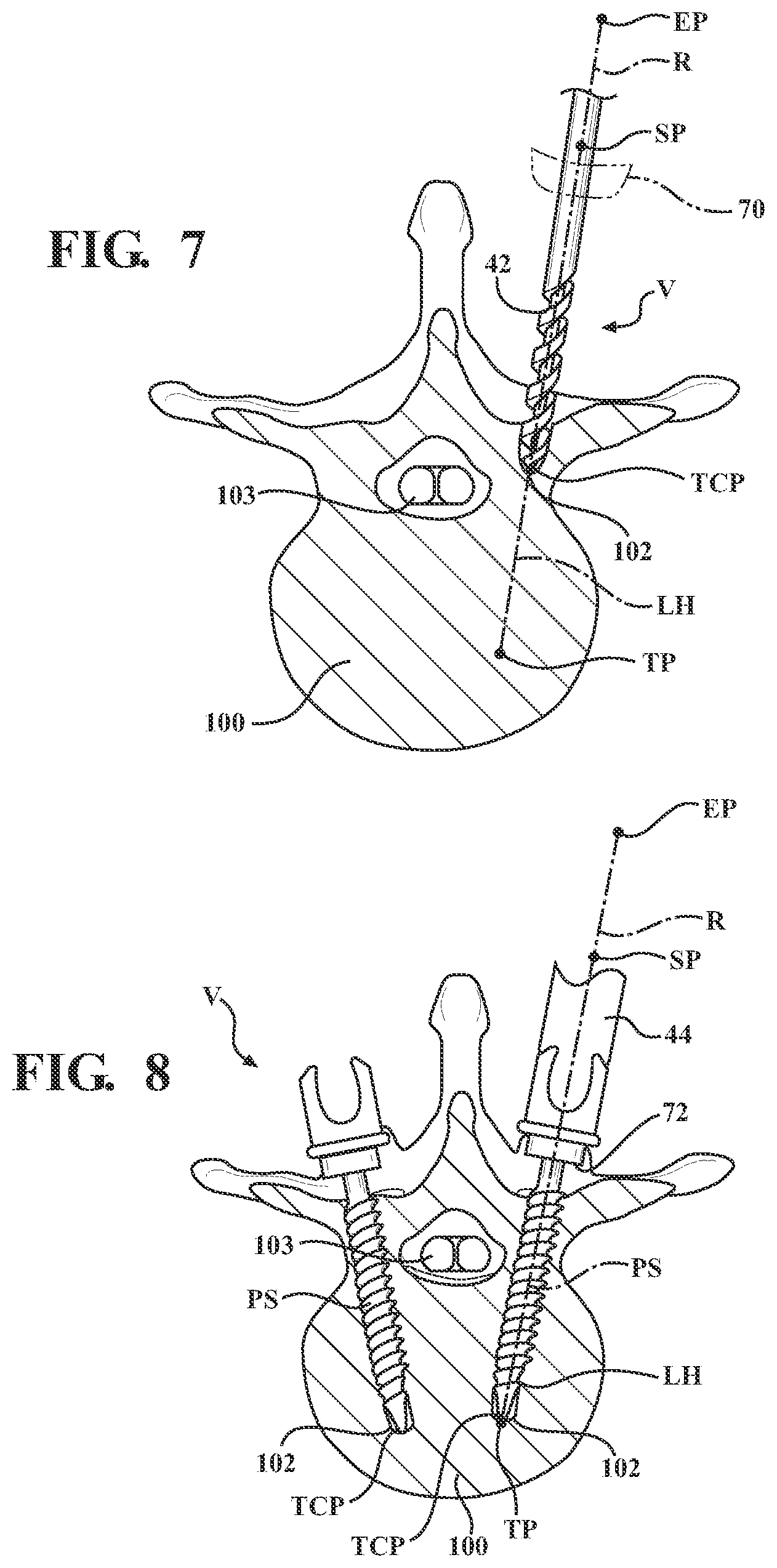 Patent US12472017 Figure 5 – Robotic spine surgery system and methods