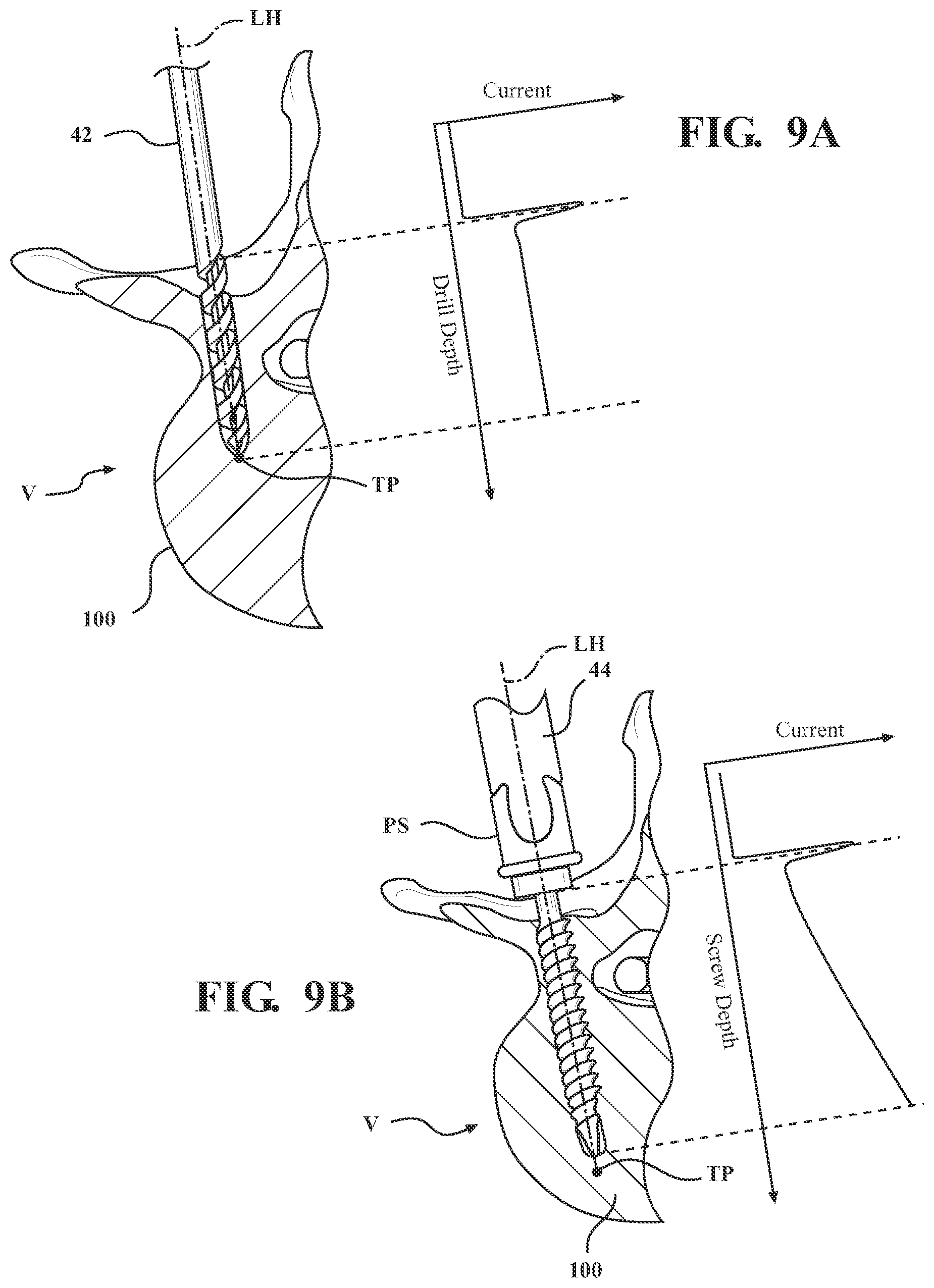 Patent US12472017 Figure 6 – Robotic spine surgery system and methods