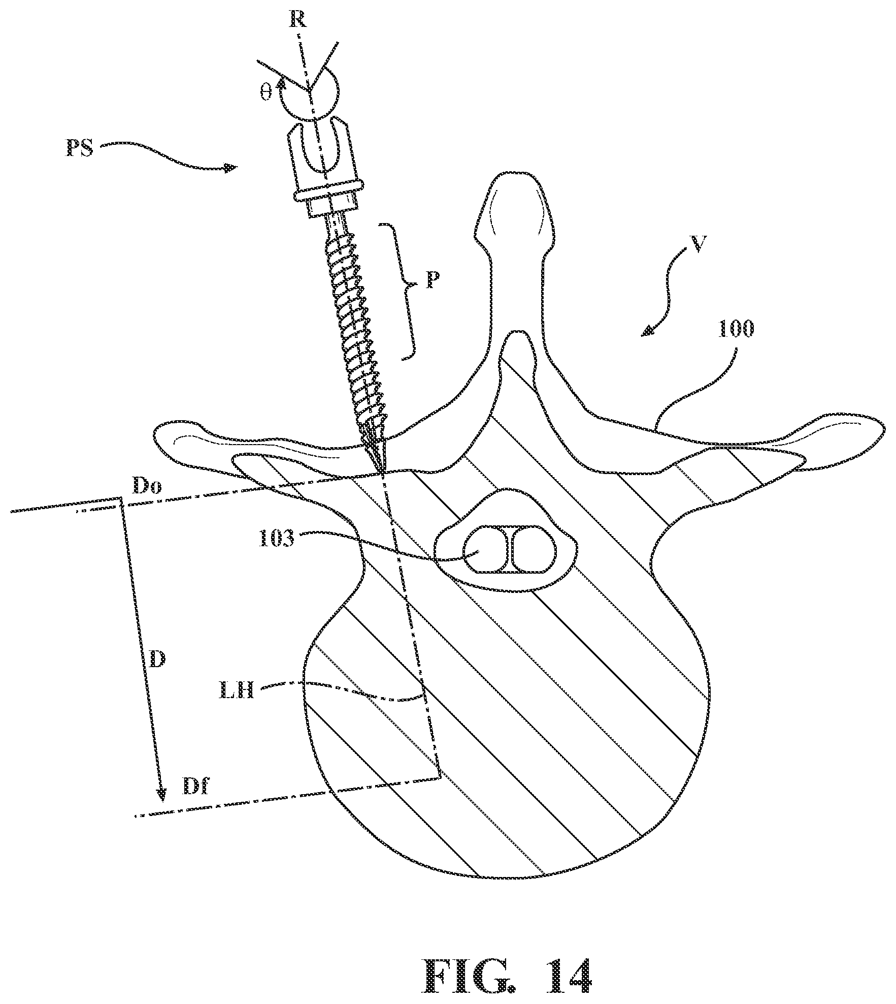 Patent US12472017 Figure 11 – Robotic spine surgery system and methods