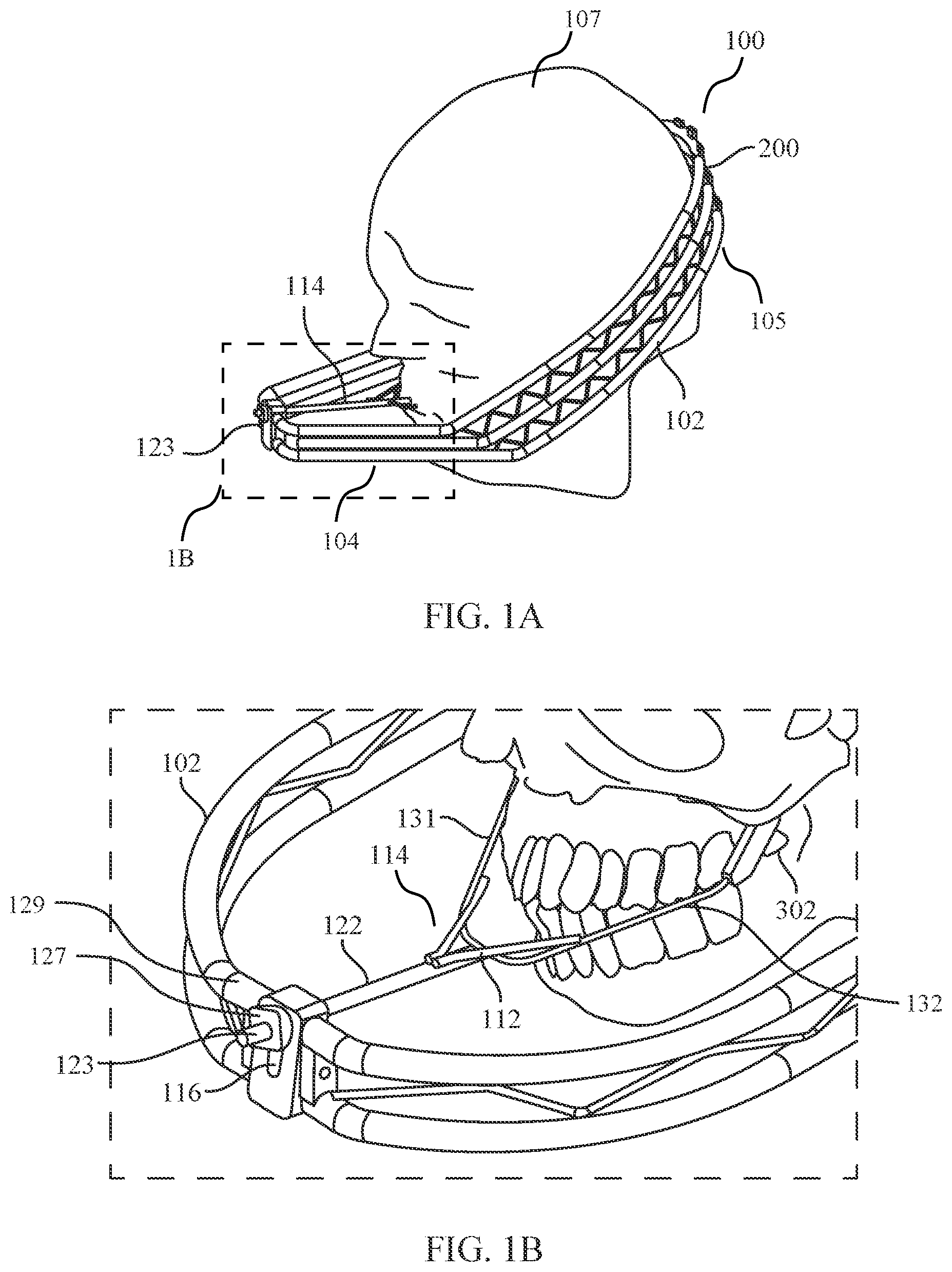 Patent US12472035 Figure 1 – Orthopedic device for midfacial bone structure advancement
